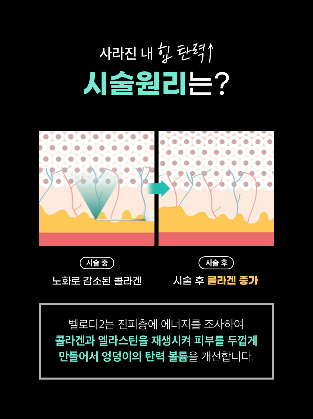 압구정 힙업 벨로디2 콜라겐 엘라스틴 재생 원리 비앤미의원