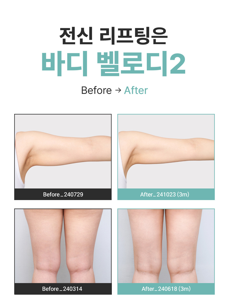 압구정 비앤미 바디벨로디2 전후 팔뚝살 리프팅 및 허벅지 탄력 비포애프터