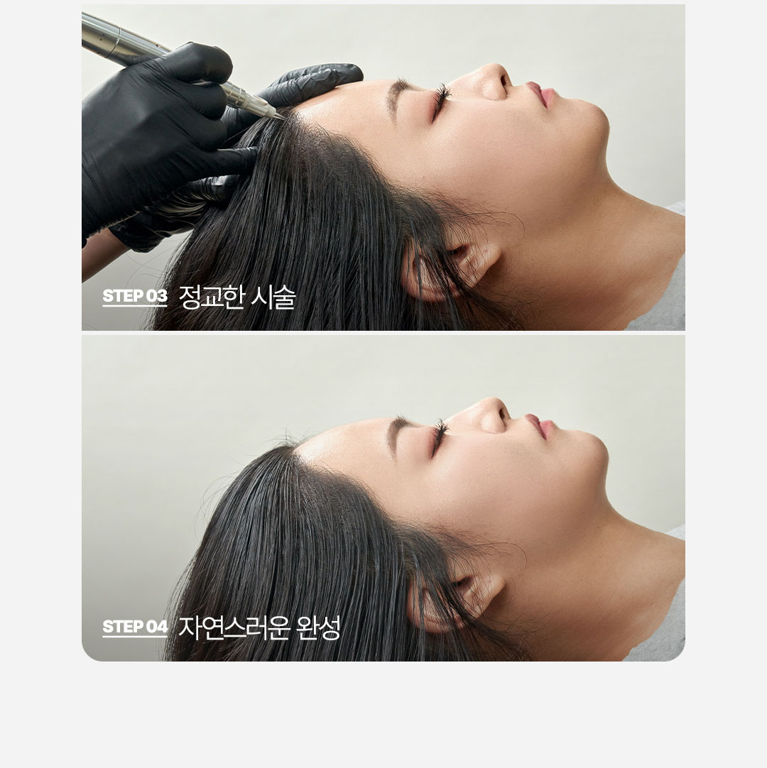 자연스러운 여자 헤어라인문신 내추럴 표현 비앤미의원