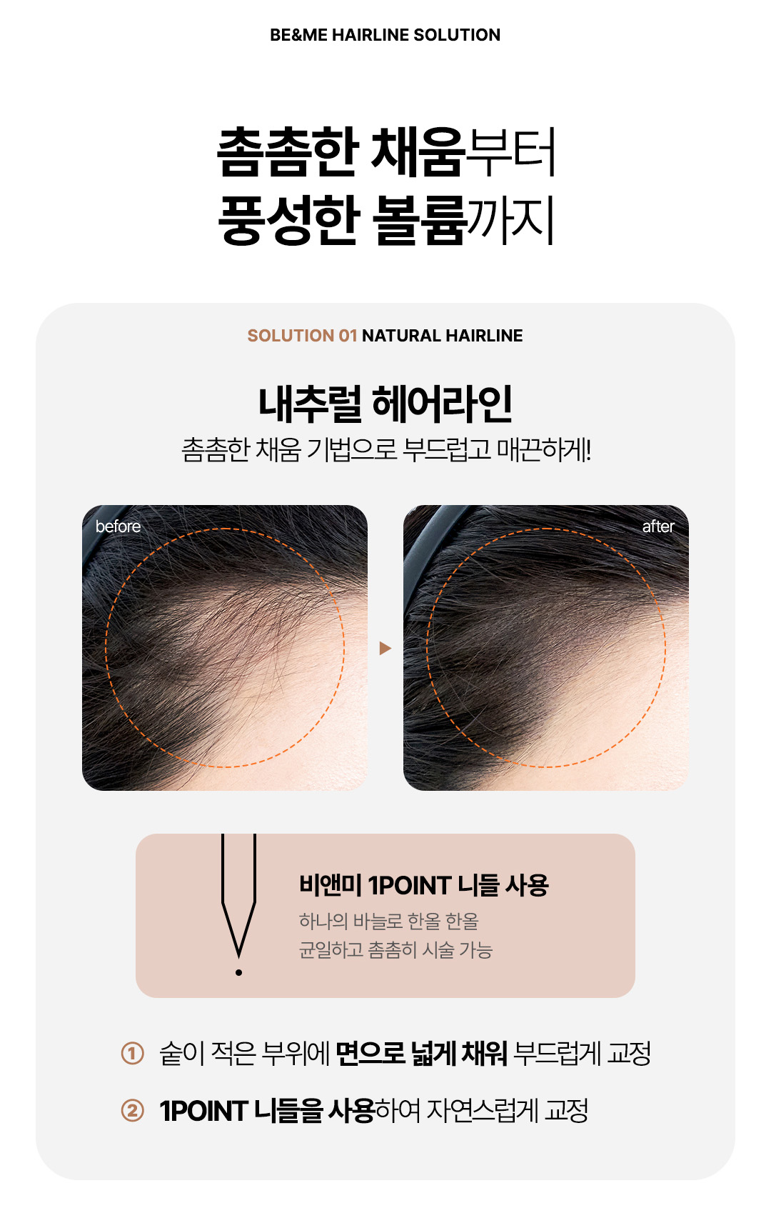 풍성하고 자연스러운 볼륨 헤어라인반영구 헤어라인 교정