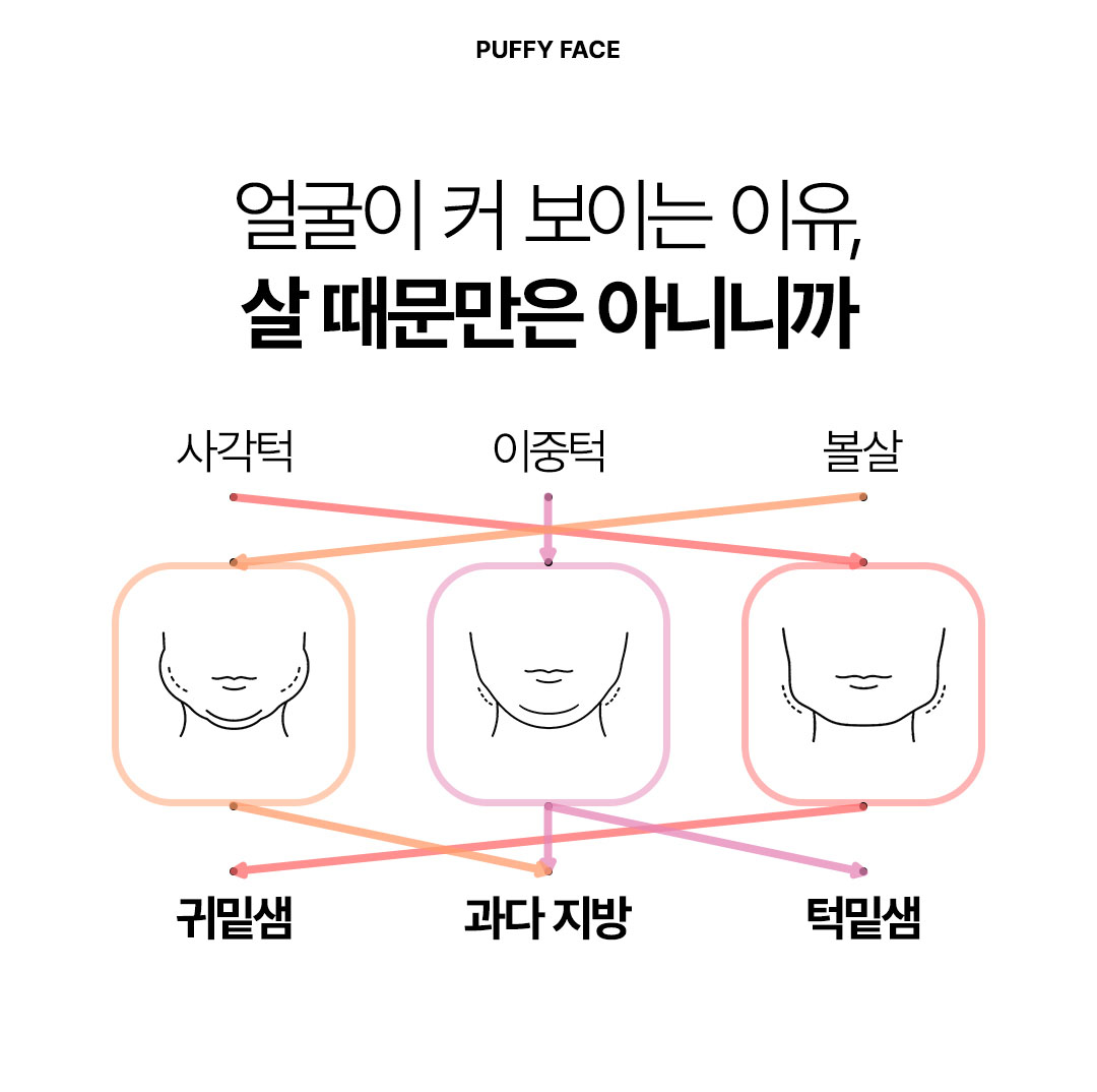 귀밑샘 턱밑샘 침샘비대증과 얼굴 지방 원인 분석 비앤미미침톡스,