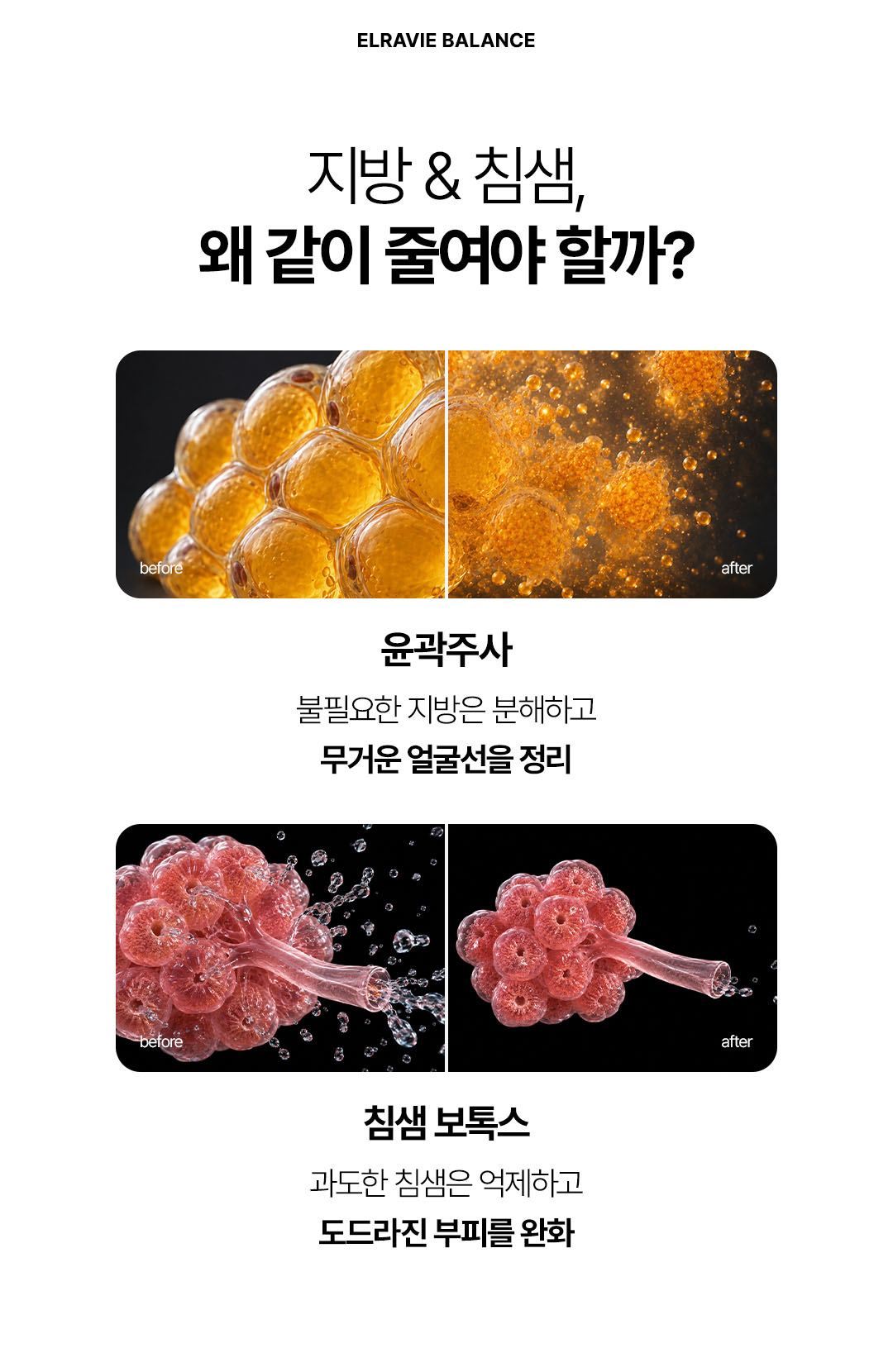 지방과 침샘을 동시에 개선하여 갸름한 턱선을 만드는 미침톡스 시술 효과 비교