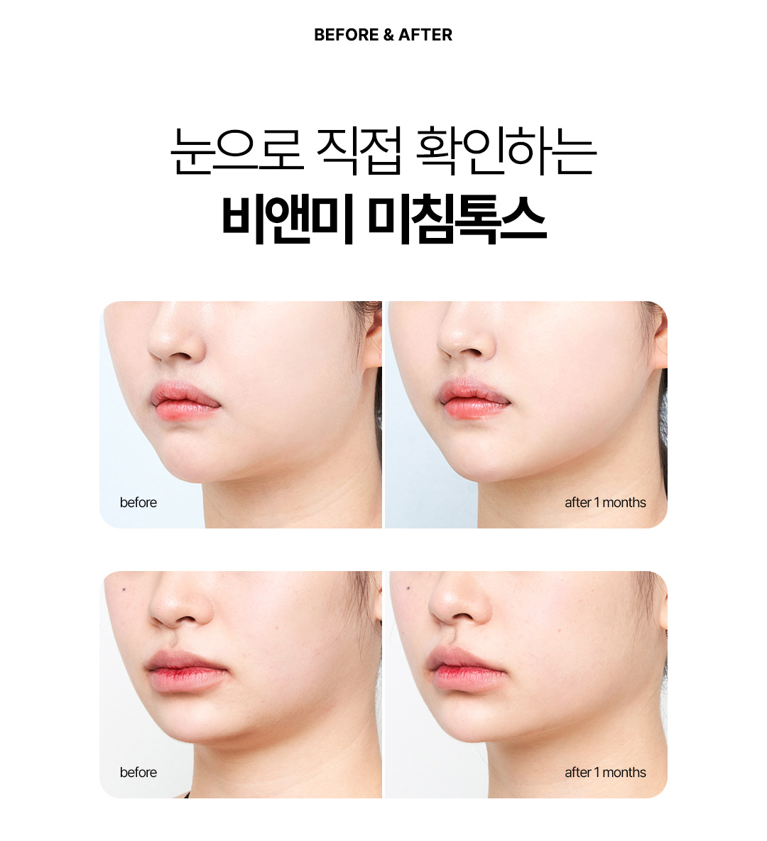 이중턱 살과 볼살을 정리하여 브이라인을 완성하는 비앤미 미침톡스