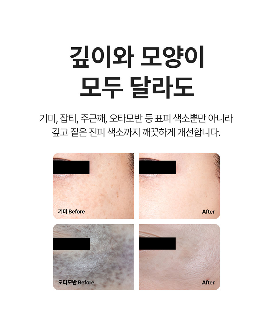 피코슈어토닝 4