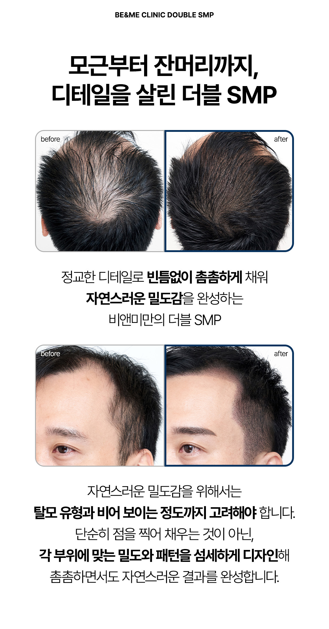 모근 고밀도 표현 자연스러운 정수리 머리문신 전후 효과 비앤미의원