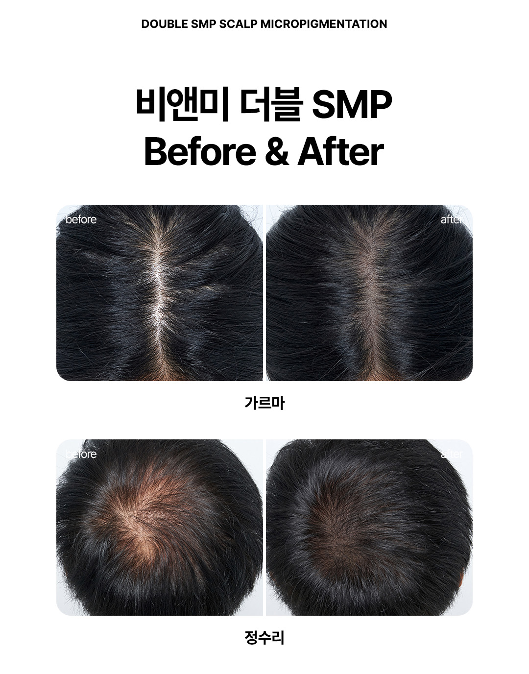 비앤미 개인 맞춤형 헤어라인 및 정수리 탈모 머리문신