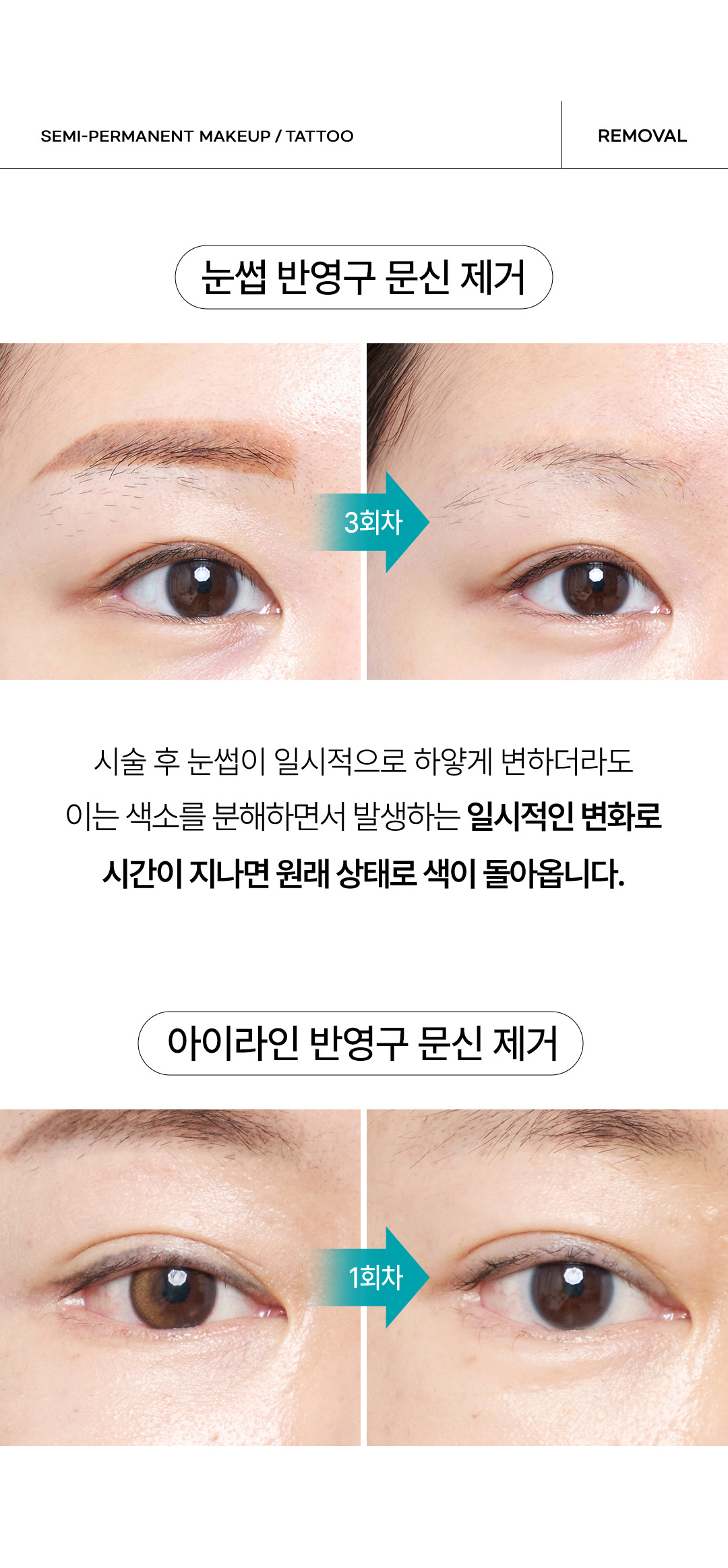 아이라인 반영구 문신 제거 통증 적고 안전한 시술 비앤미