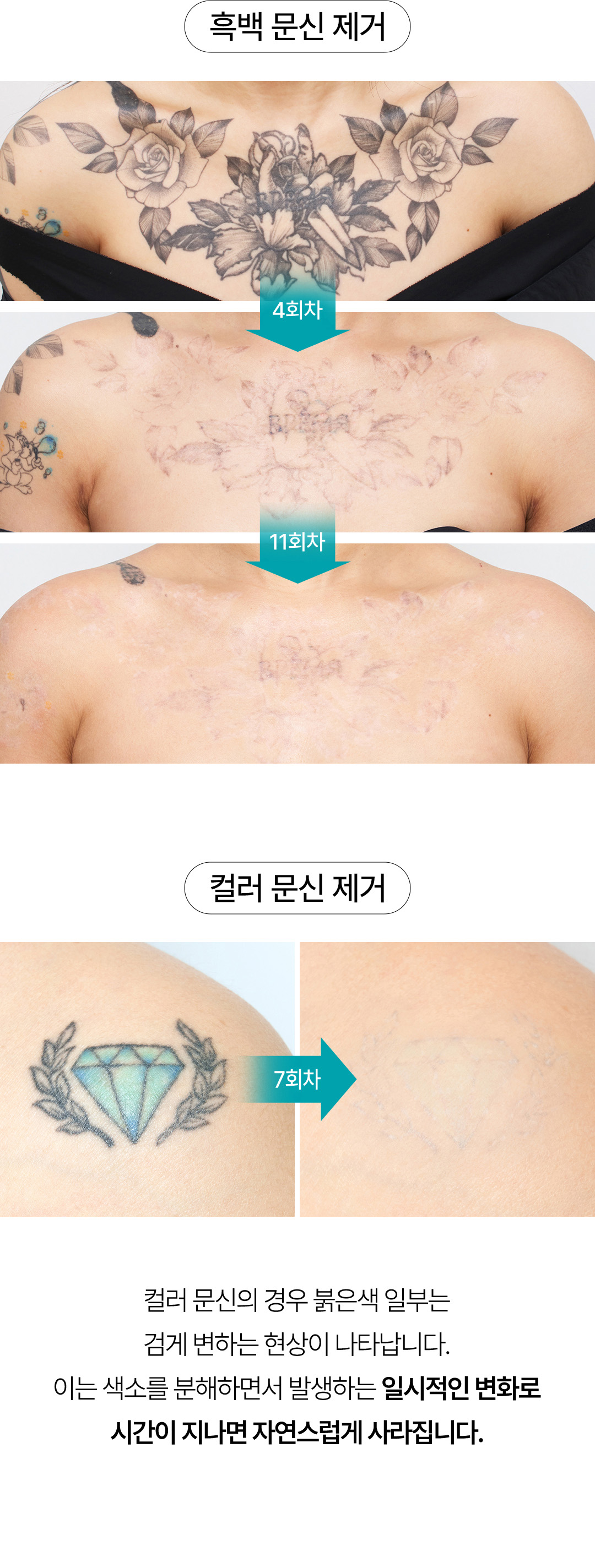 붉은 눈썹 잔흔 제거 잘하는곳 압구정 비앤미의원