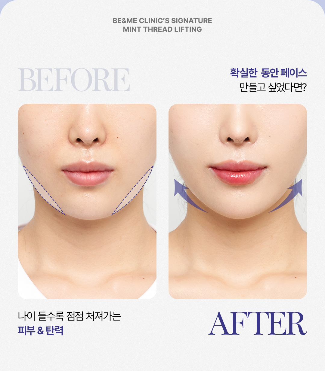 얼굴 처짐 및 이중턱 팔자주름 개선 민트실리프팅 시술 대상