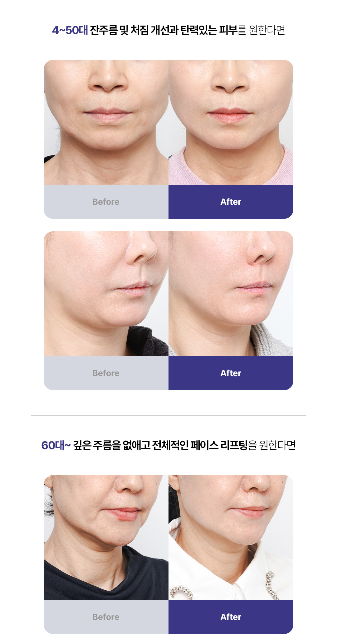 비앤미의원 이중턱 및 턱선 민트실리프팅 시술 전후 변화