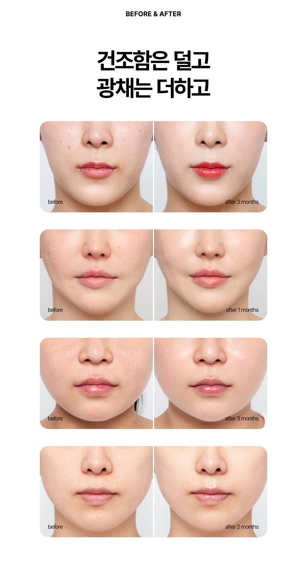물광주사, 수분주사, 물광주사후기, 물광주사효과, 물광주사통증, 물광주사가격, 물광주사내돈내산, 물광주사엠보, 강남물광주사