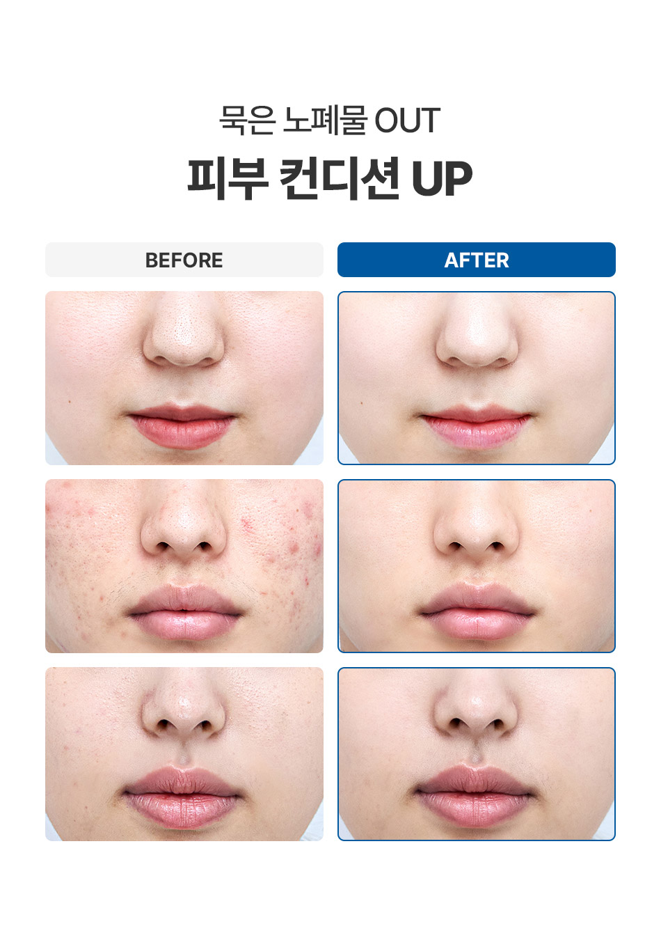 압구정 모공 속 노폐물 수분 충전 필링 비앤미의원