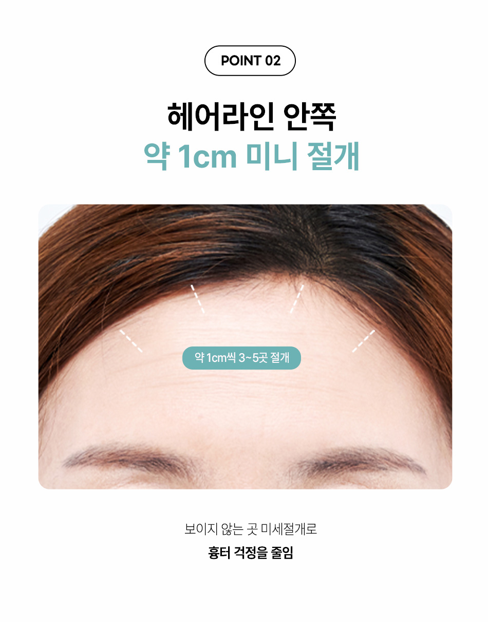 강남 압구정 내시경 이마거상 두피 안쪽 미니 절개로 흉터 걱정 없는 눈썹거상