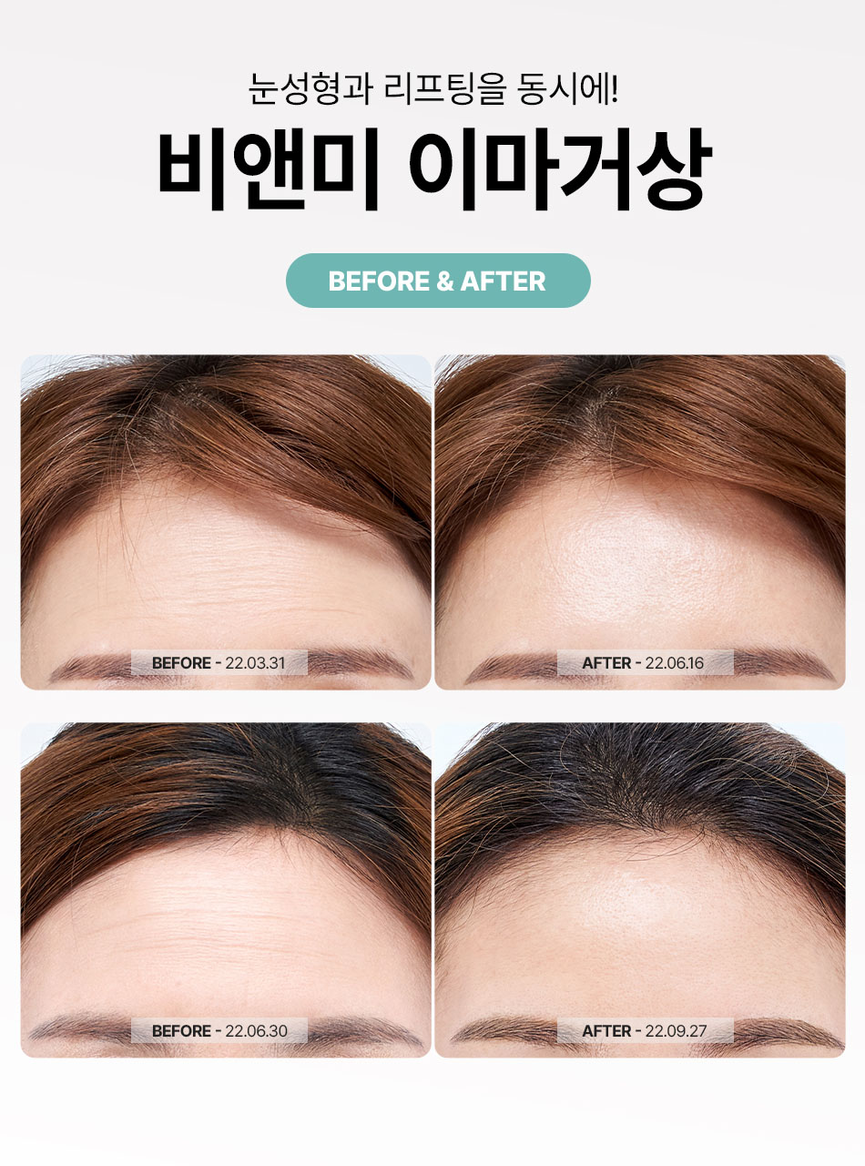 압구정 비앤미 이마거상 전후 사진 처진 눈썹 및 이마주름 개선 비포애프터