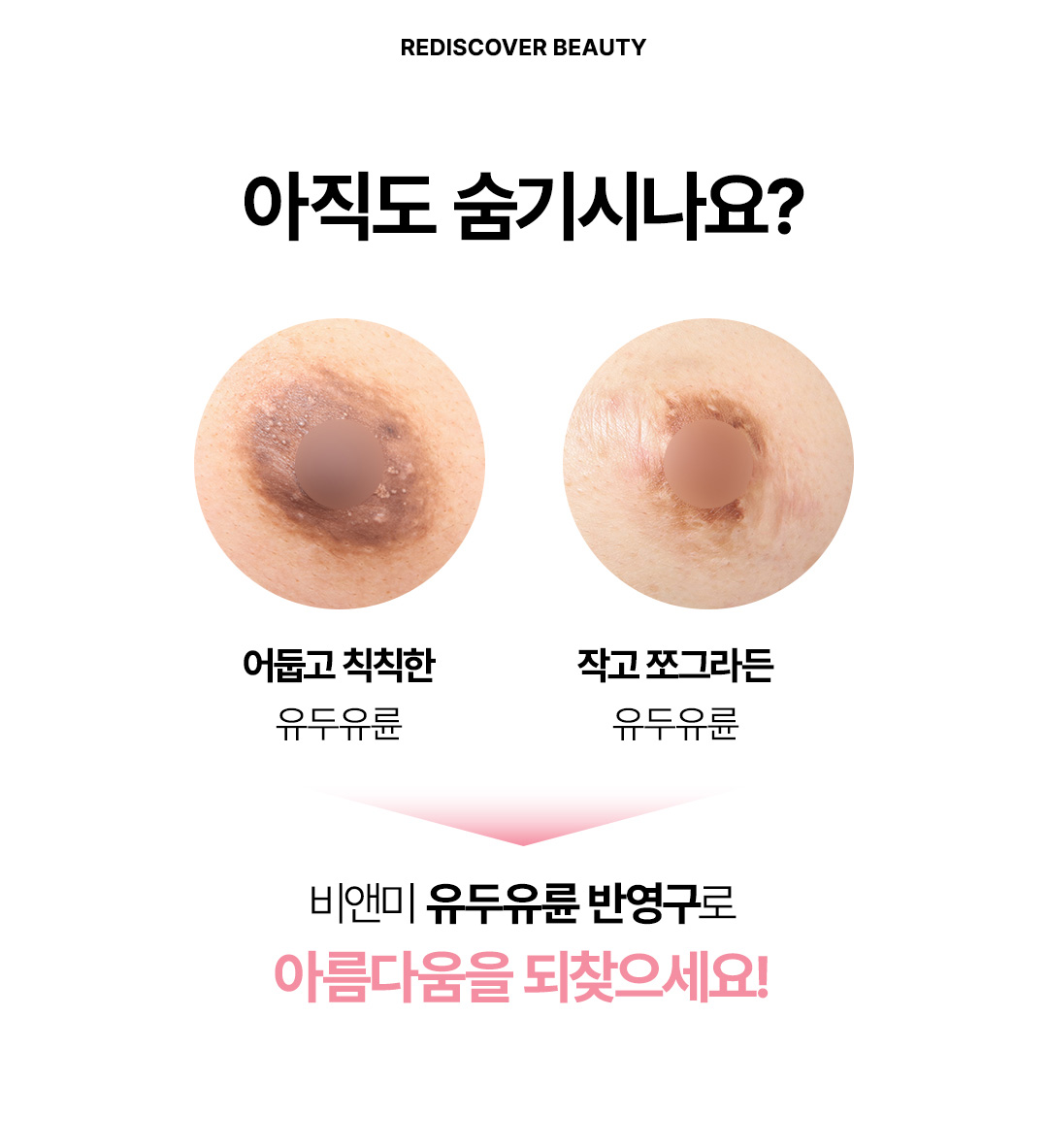 압구정 비앤미의원 유두 유륜 반영구 시술