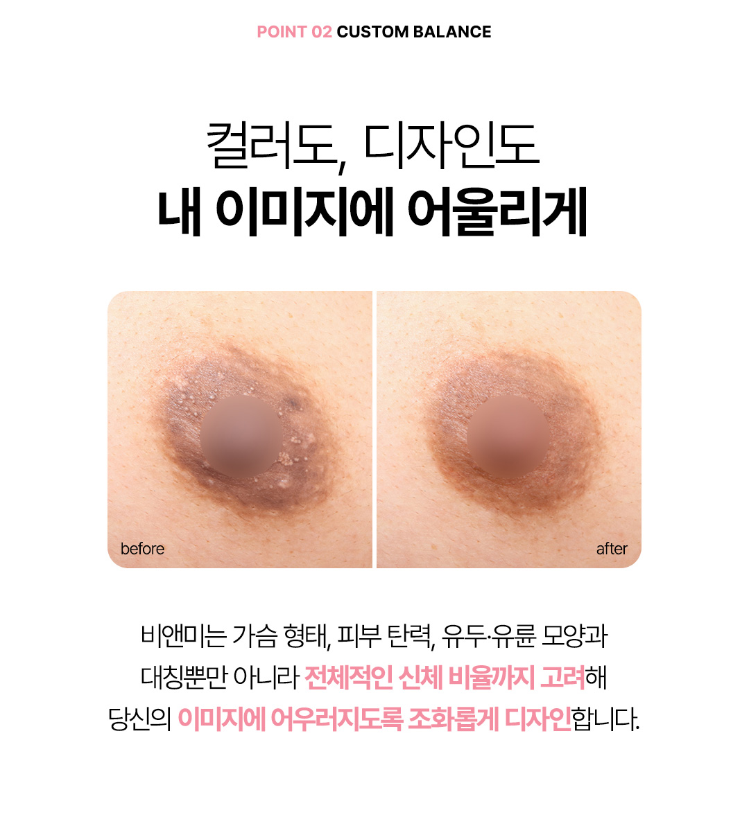 메디컬 타투 유륜 색상 교정 및 흉터 커버 비앤미의원