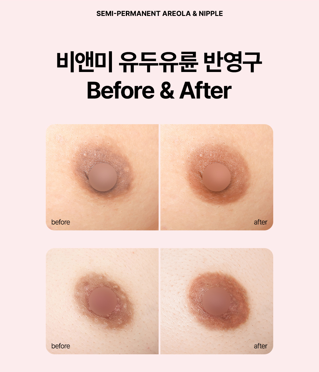 메디컬 타투 유륜 색상 교정 및 흉터 커버 비앤미의원