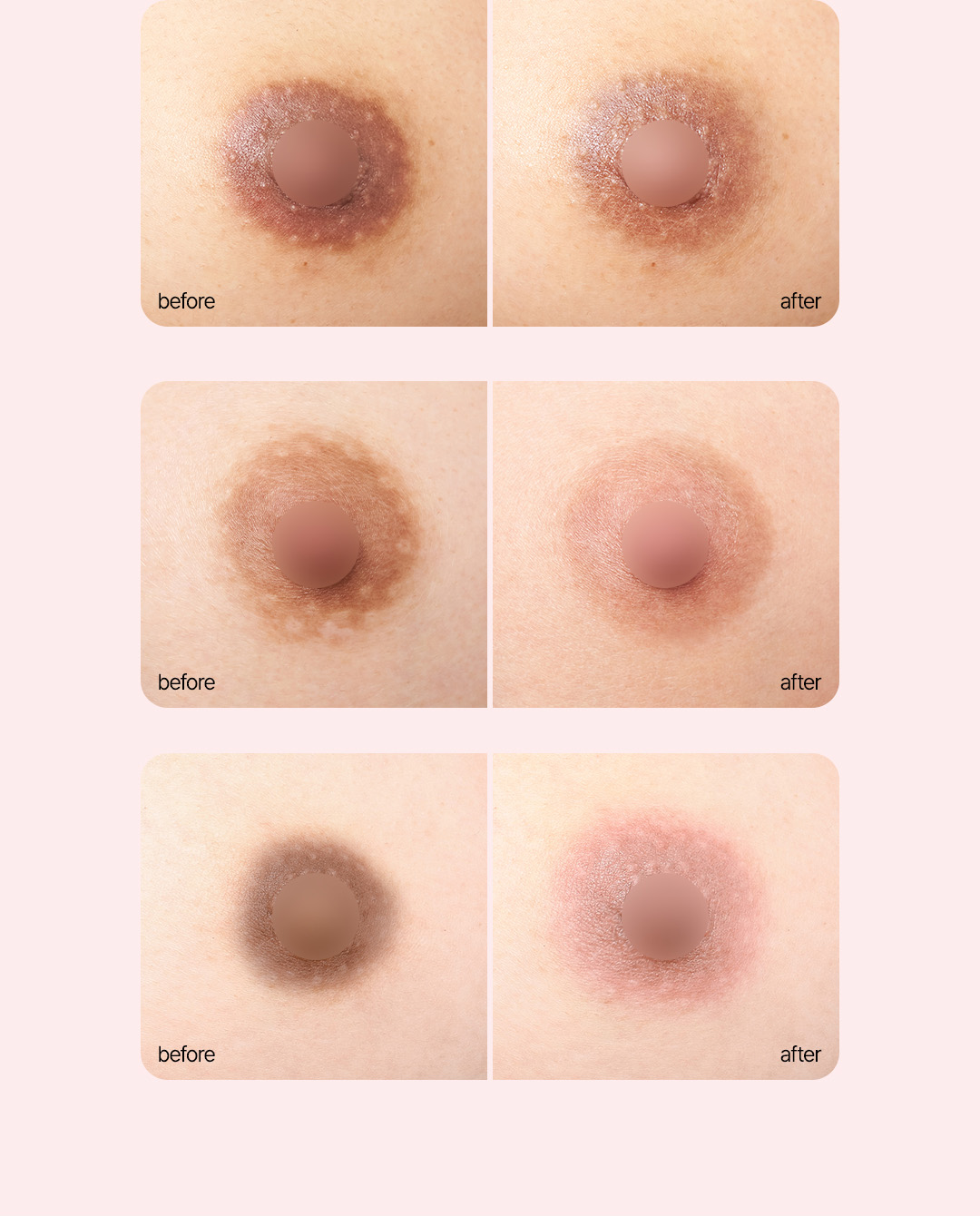 메디컬 타투 유륜 색상 교정 및 흉터 커버 비앤미의원