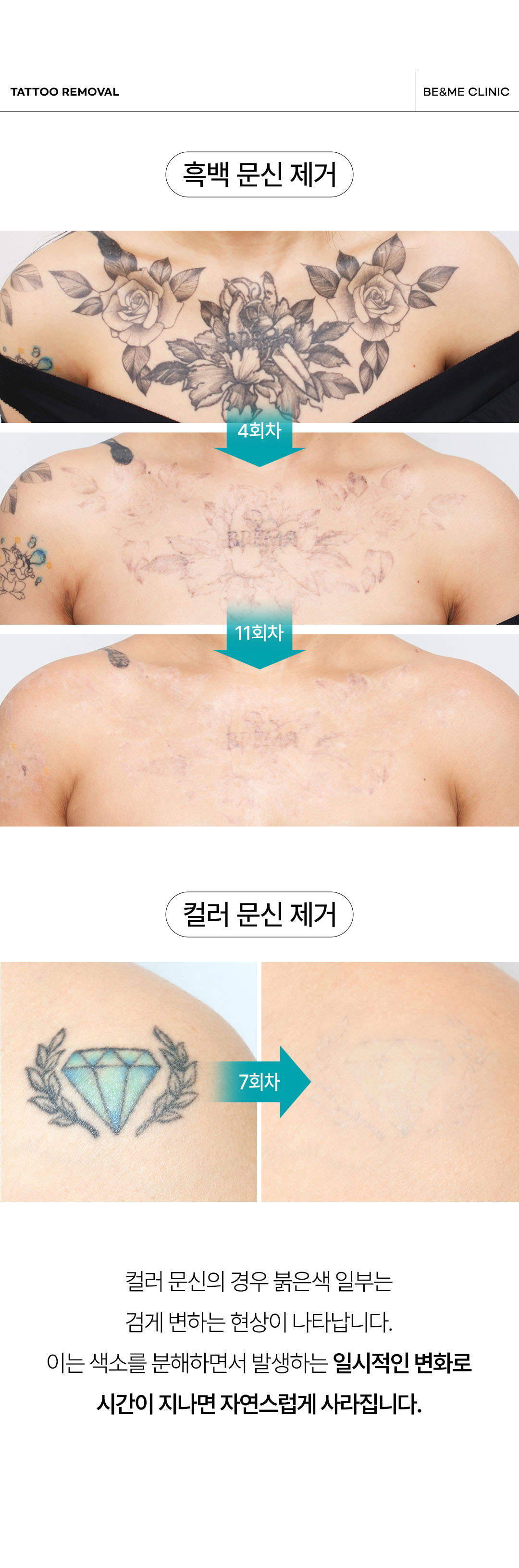강남 역구정역 문신제거 잘하는 곳 피부과 추천 비앤미
