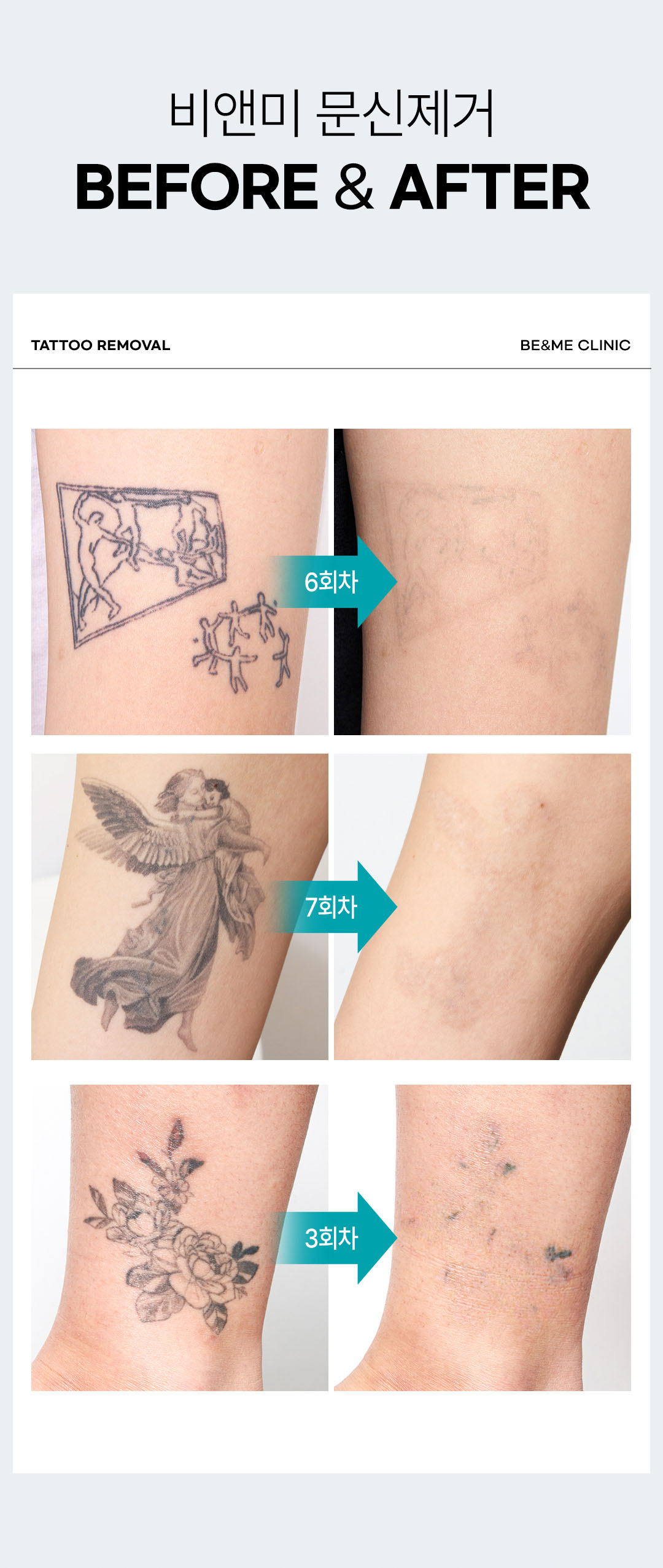 강남 역구정역 문신제거 잘하는 곳 피부과 추천 비앤미