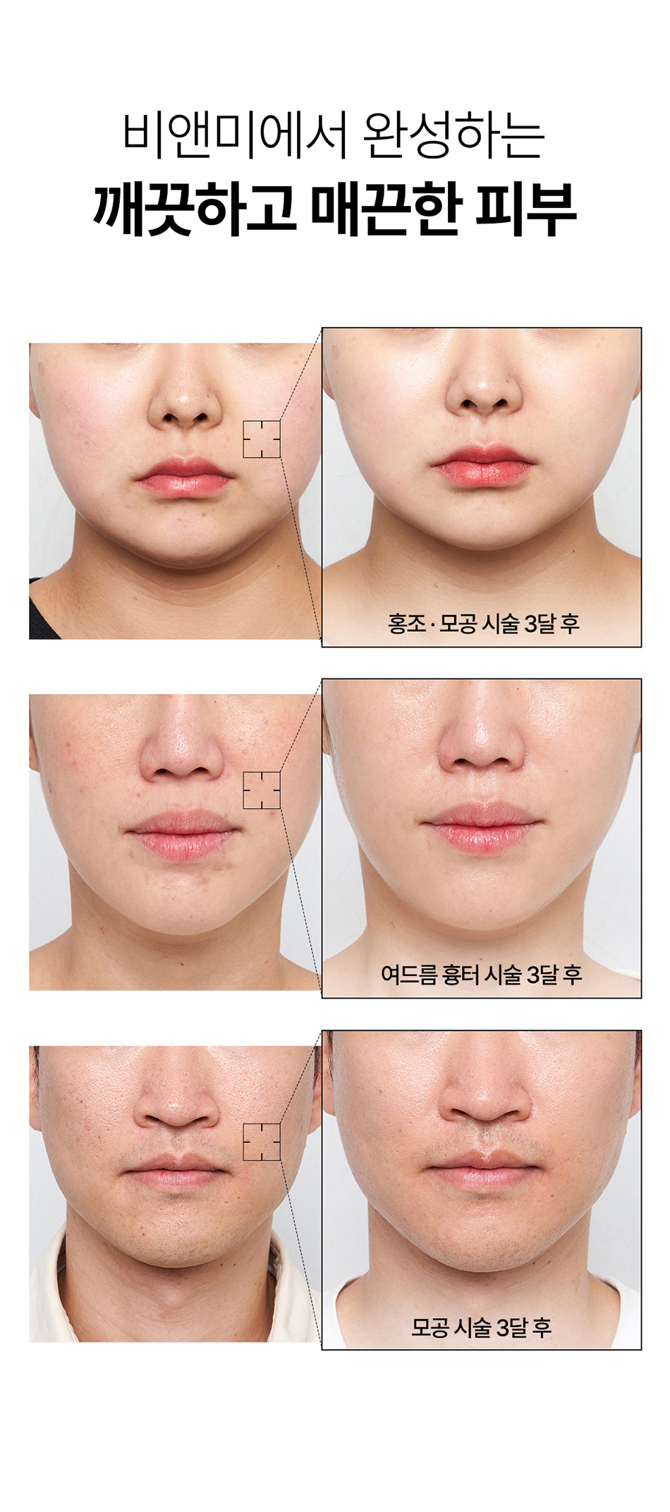 모공 축소 및 여드름 흉터 개선 포텐자 압구정 배인미 의원