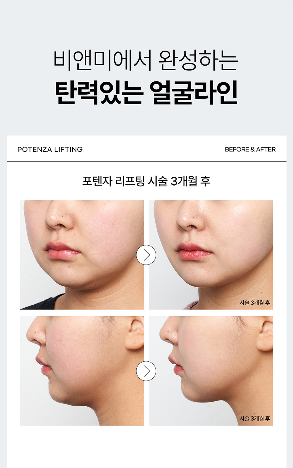 압구정 비앤미의원 압구정피부과 강남피부과 압구정성형외과 강남성형외과 포텐자 리프팅 효과 포텐자 리프팅 후기 포텐자 리프팅 300샷 포텐자 효과 포텐자 후기 포텐자 가격 포텐자 통증 포텐자 부작용 포텐자 주기 포텐자 다운타임 포텐자 술