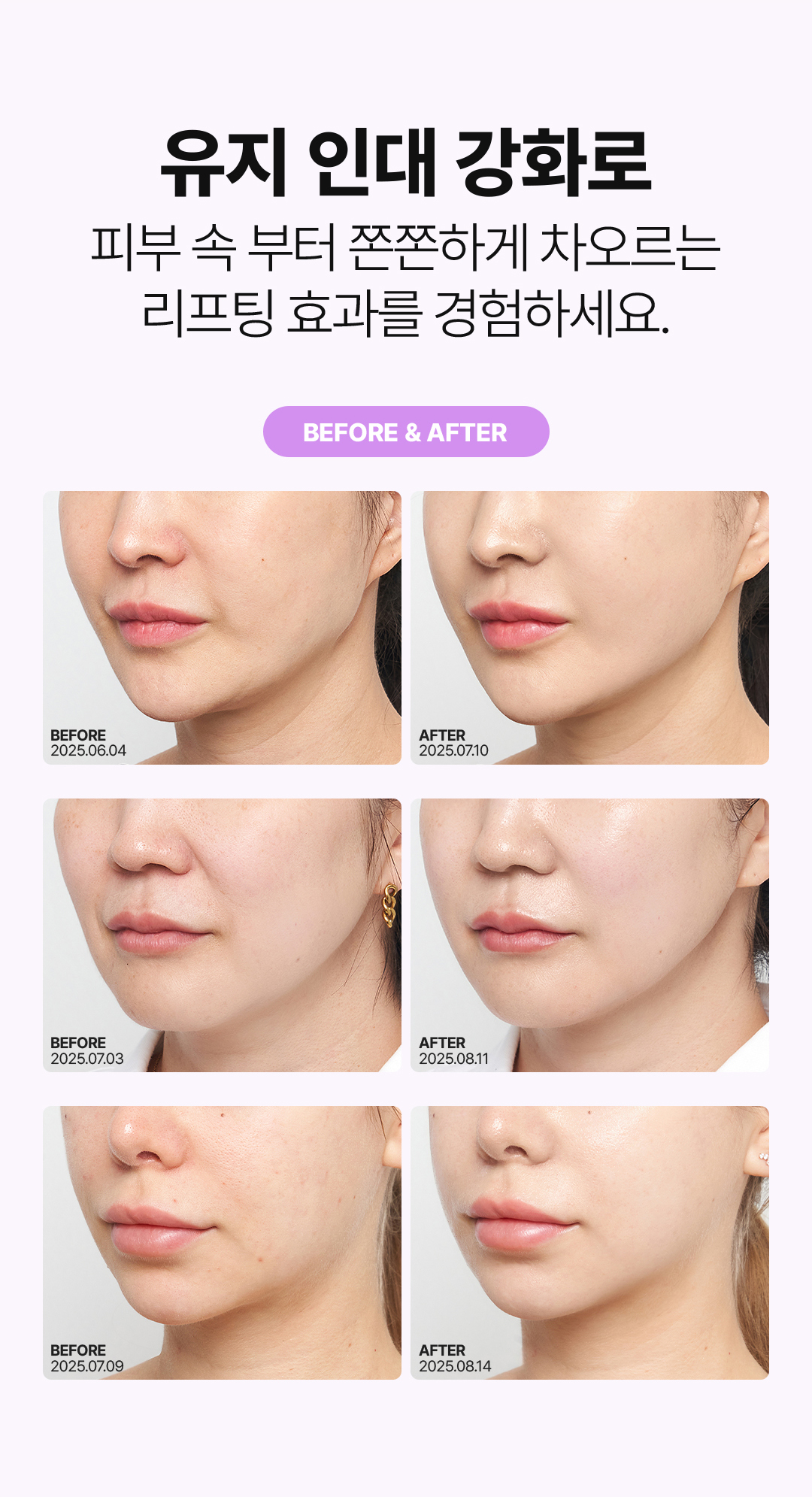 압구정 비앤미의원 티타늄 리프팅 시술