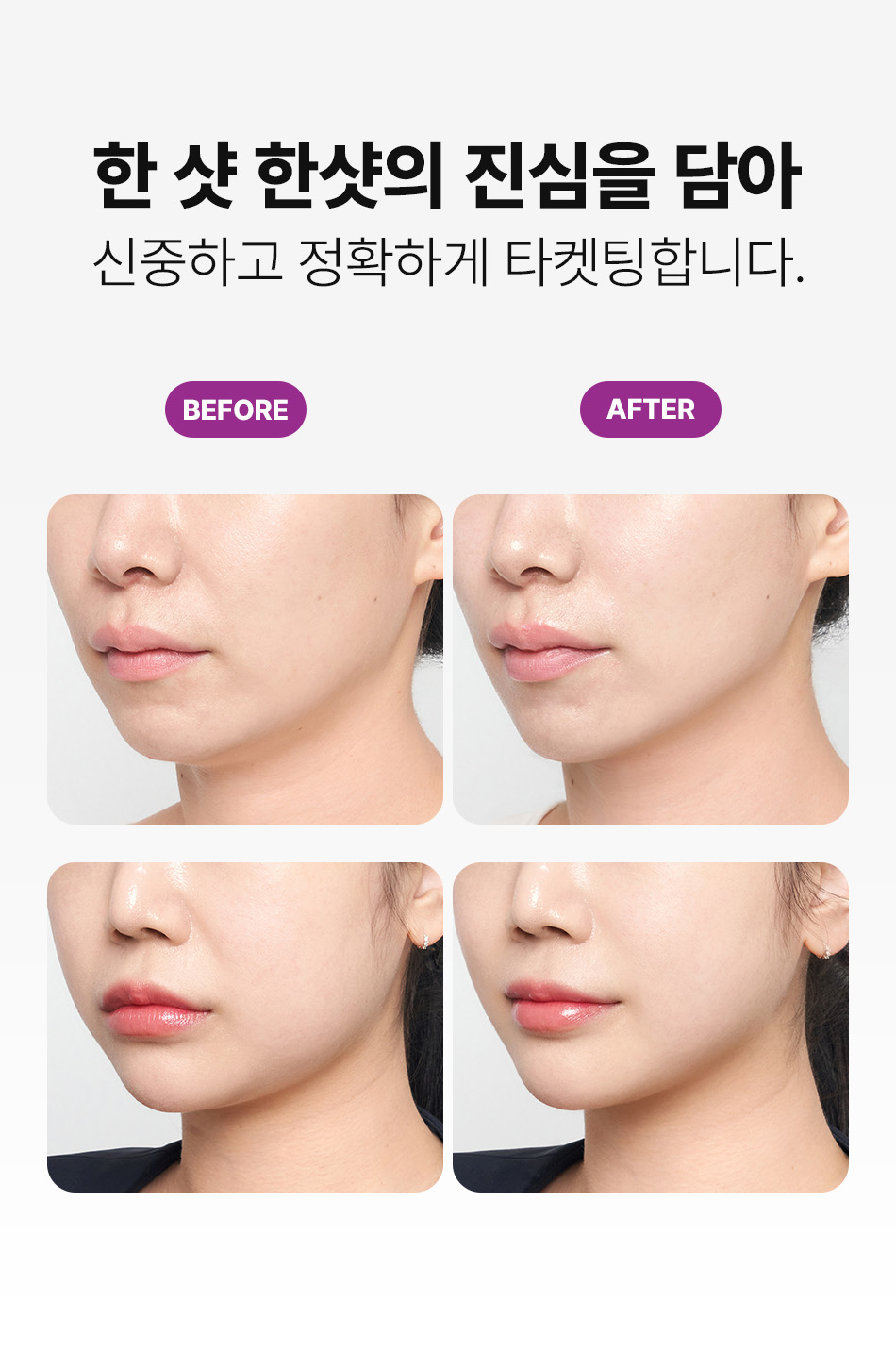 압구정 비앤미의원 써마지FLX 정품 팁 사용 인증병원 비앤미 써마지리프팅