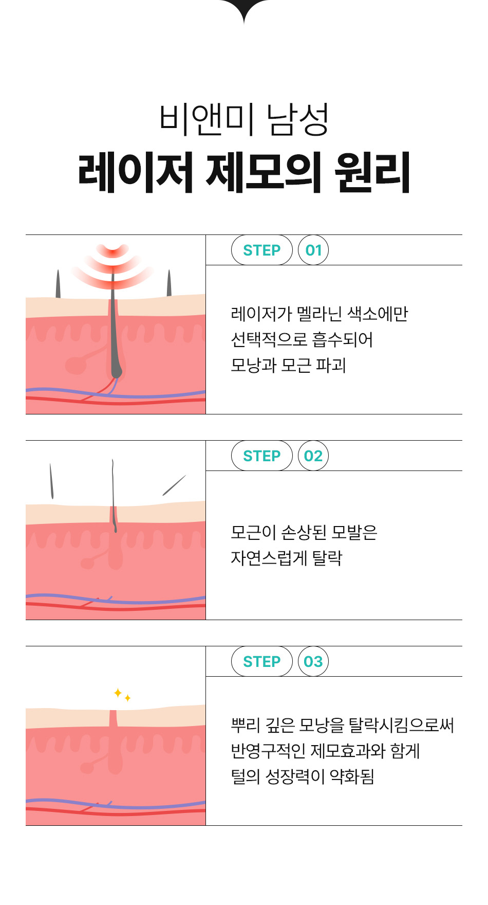 남자 턱수염 레이저 제모 원리 멜라닌 색소 타깃 모낭 파괴 반영구 제모
