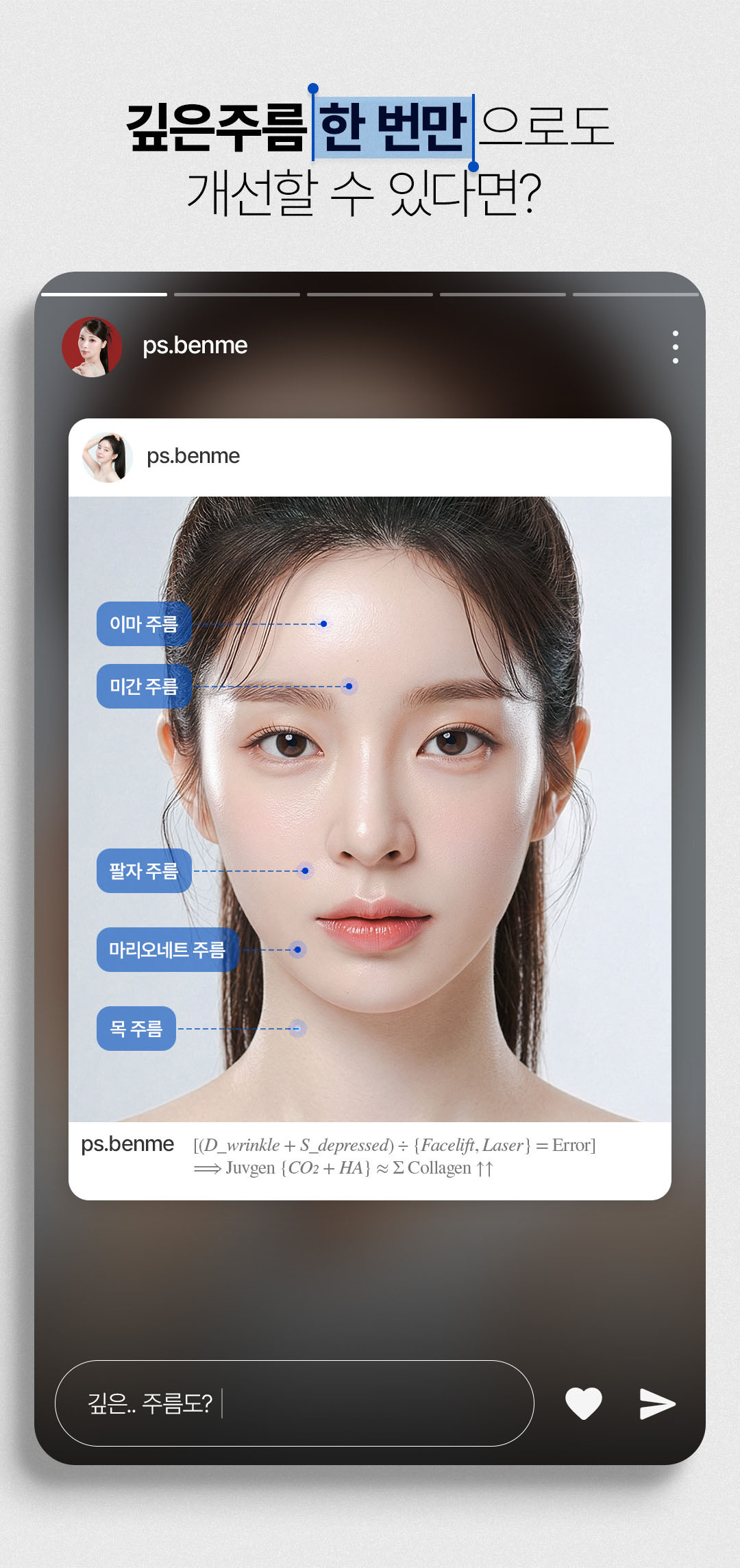 깊은 팔자주름 제거 쥬브젠 자가진피 재생 시술 비앤미의원