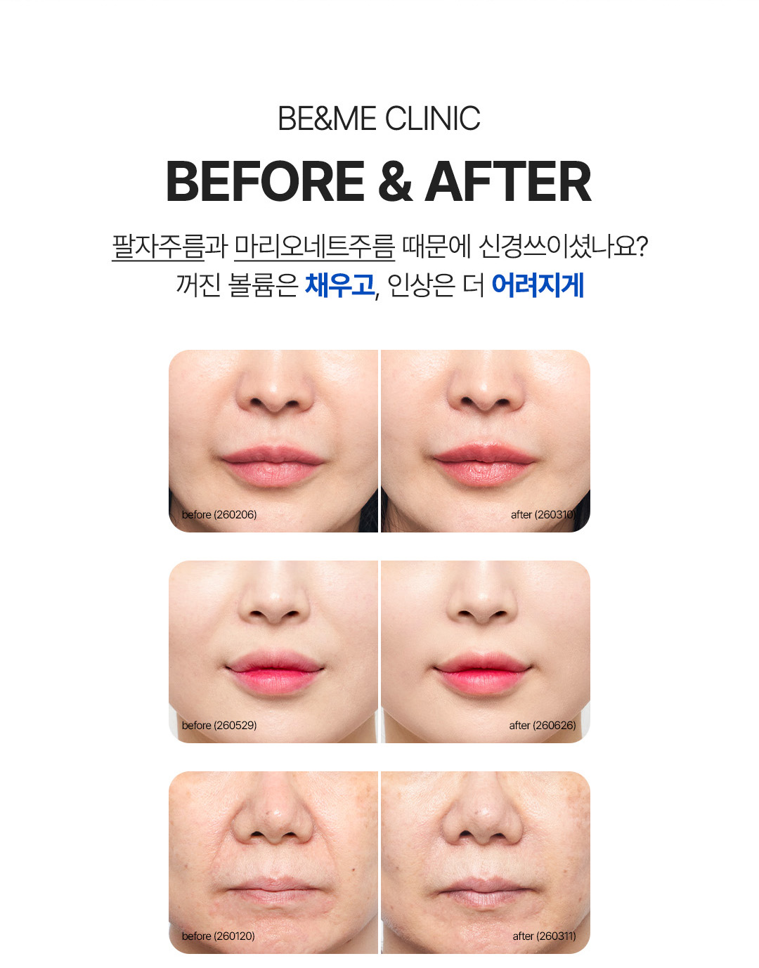 압구정 비앤미의원 쥬브젠 자가진피 재생술