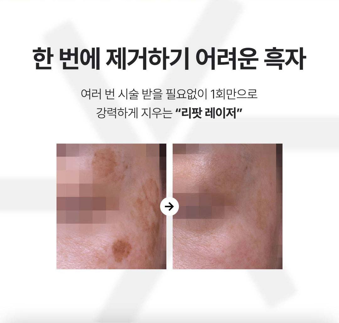 리팟레이저 이미지2
