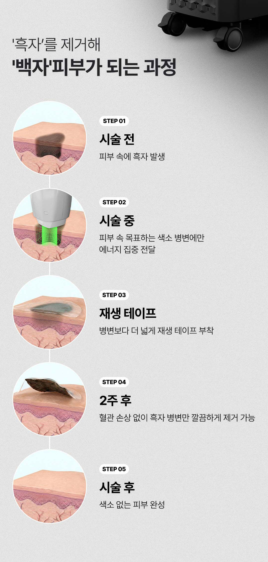 흑자 제거 비용 흑자 제거 패치 흑자 제거 후기 기미 흑자 제거 흑자 제거 병원 흑자 제거 레이저 흑자 제거 후 듀오덤 강남 흑자 가격 압구정 비앤미의원