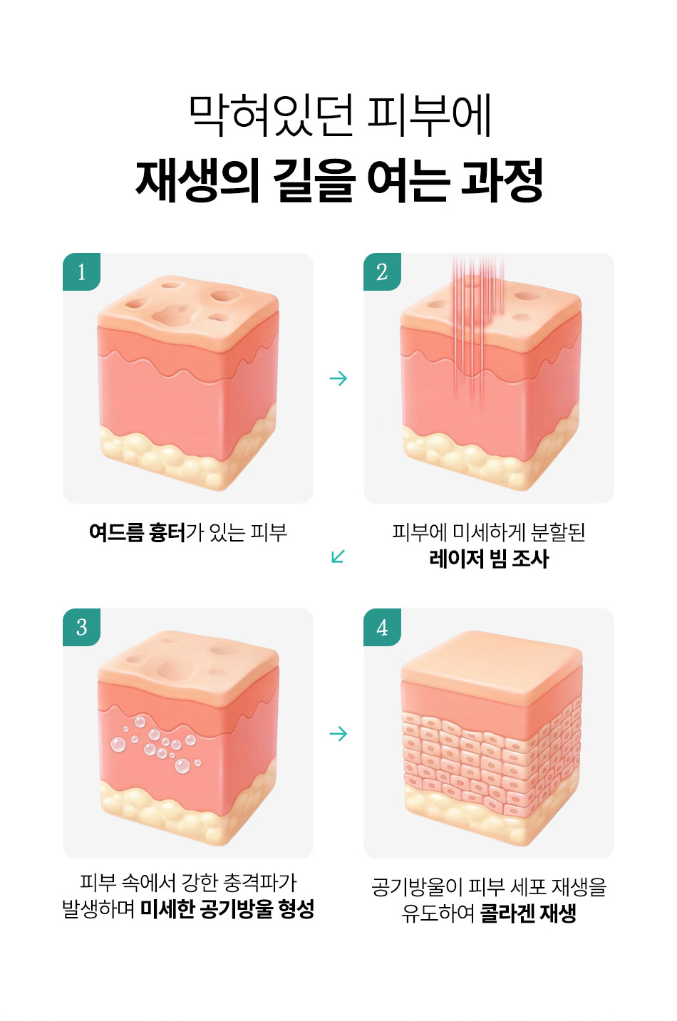 압구정 마이크로 레이저빔 피부 세포 재생 원리 비앤미의원