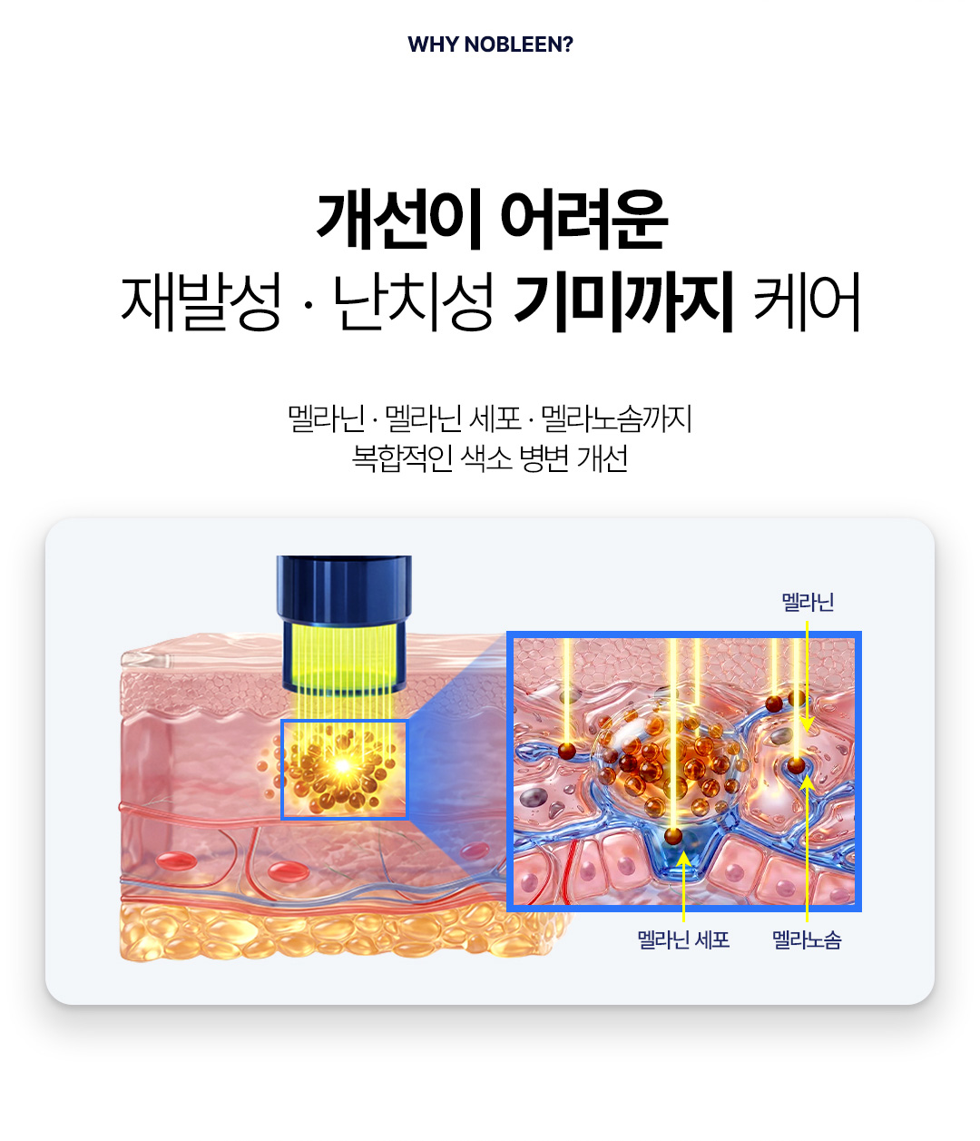 재발성 난치성 기미 및 색소질환 레이저 치료 압구정 비앤미 피부