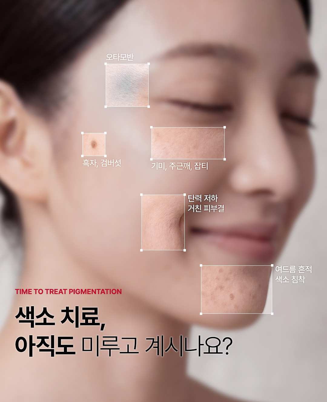 압구정 색소치료 기미 잡티부턱 흑자와 오타모반 검버섯 맞춤설계 색소치료 압구정비앤미의원