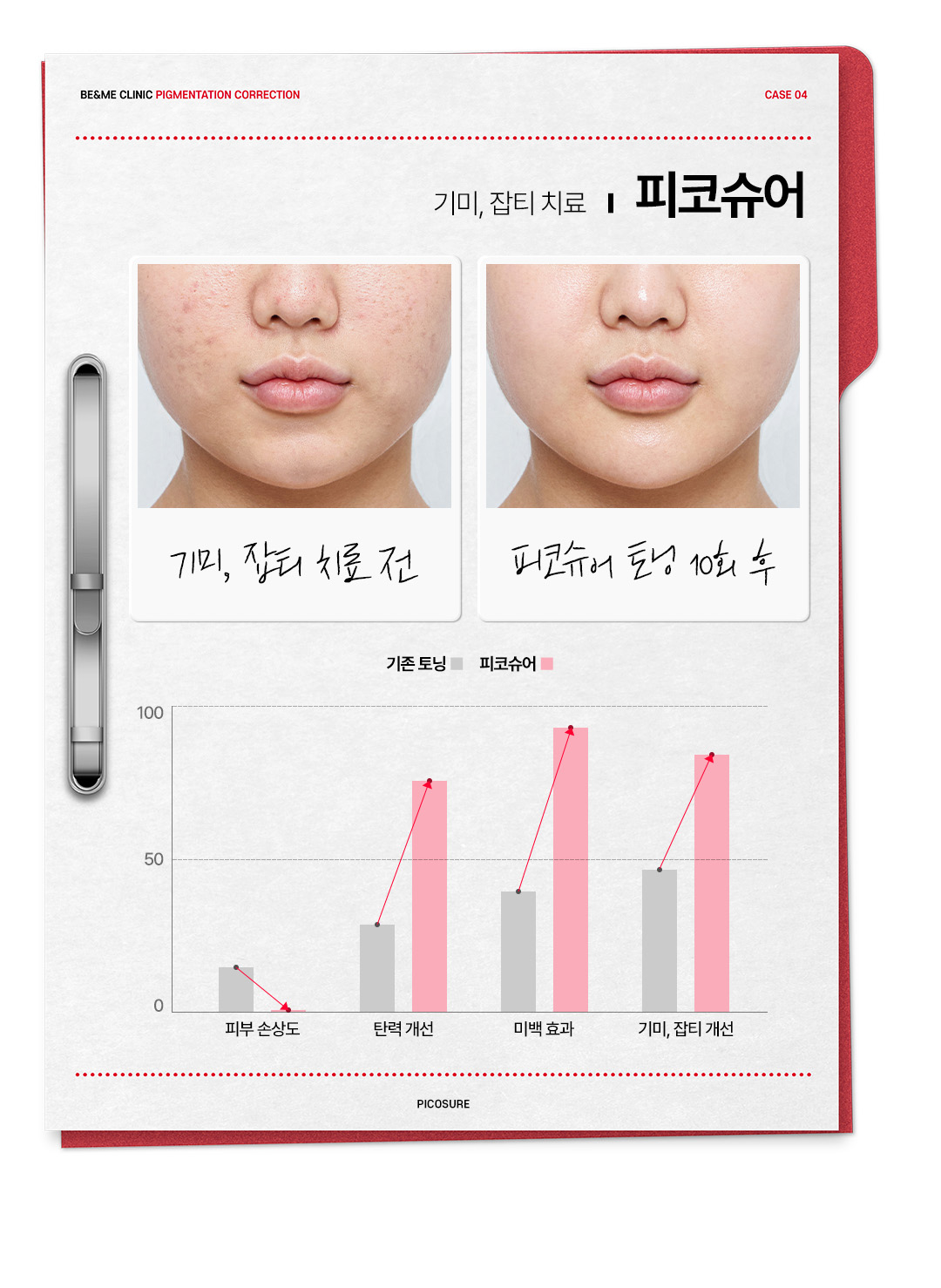 압구정 색소치료 기미 잡티부턱 흑자와 오타모반 검버섯 맞춤설계 색소치료 압구정비앤미의원