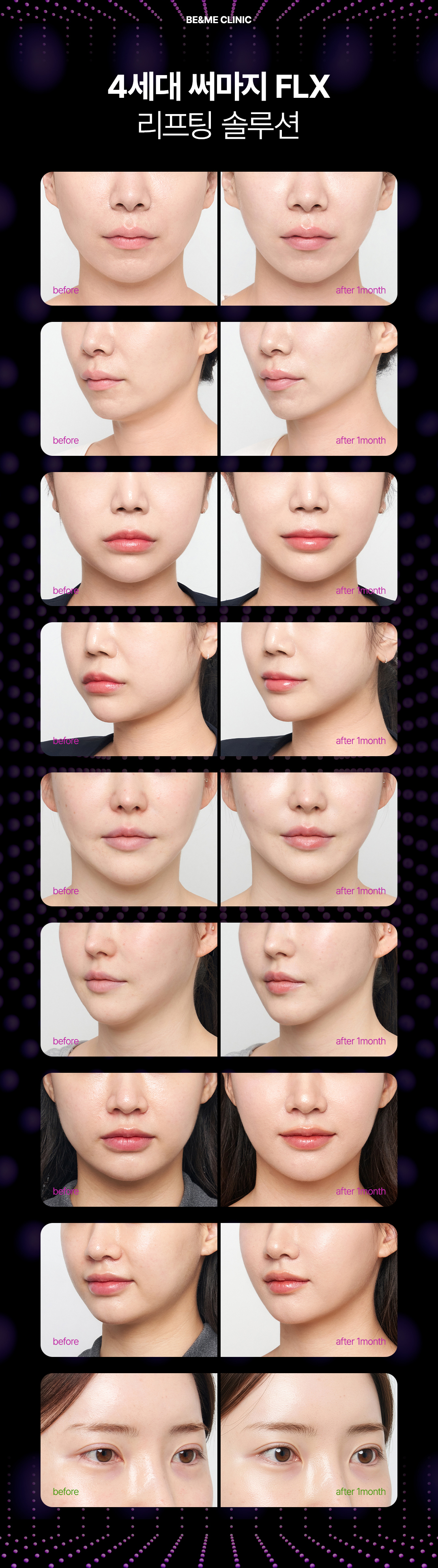 써마지 600 샷 한정 이벤트 3