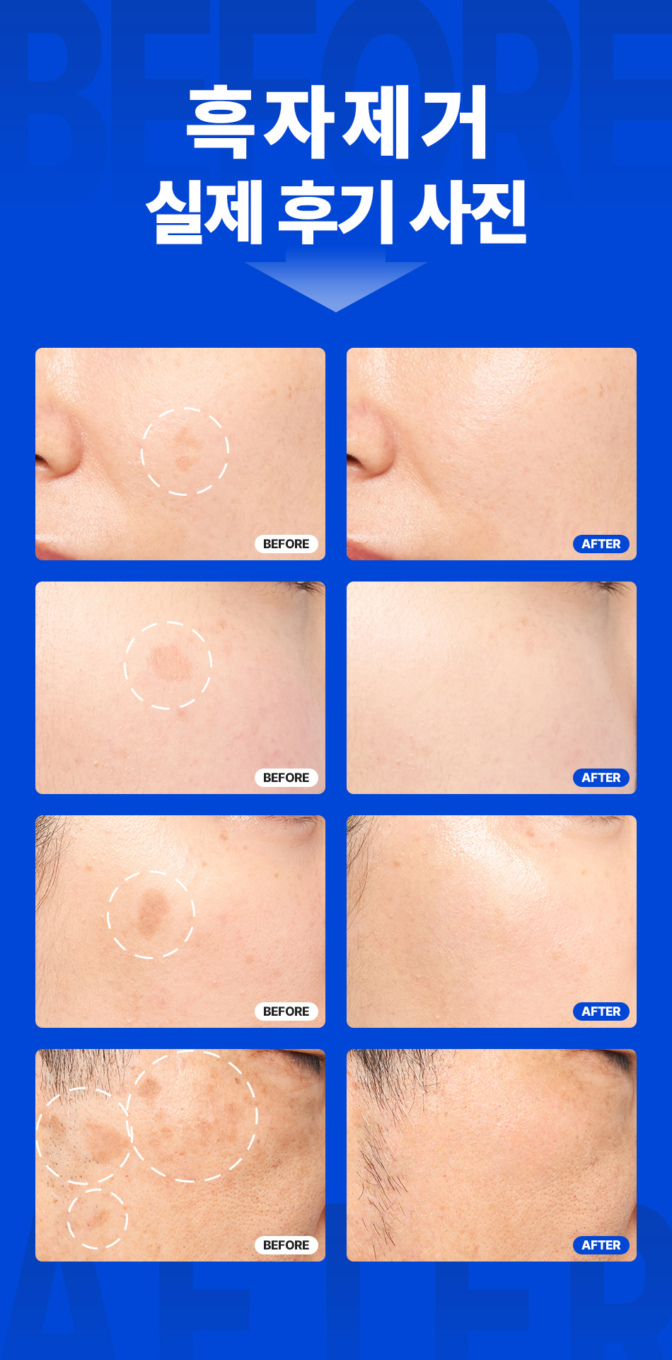 흑자제거 리팟레이저 한정이벤트 2