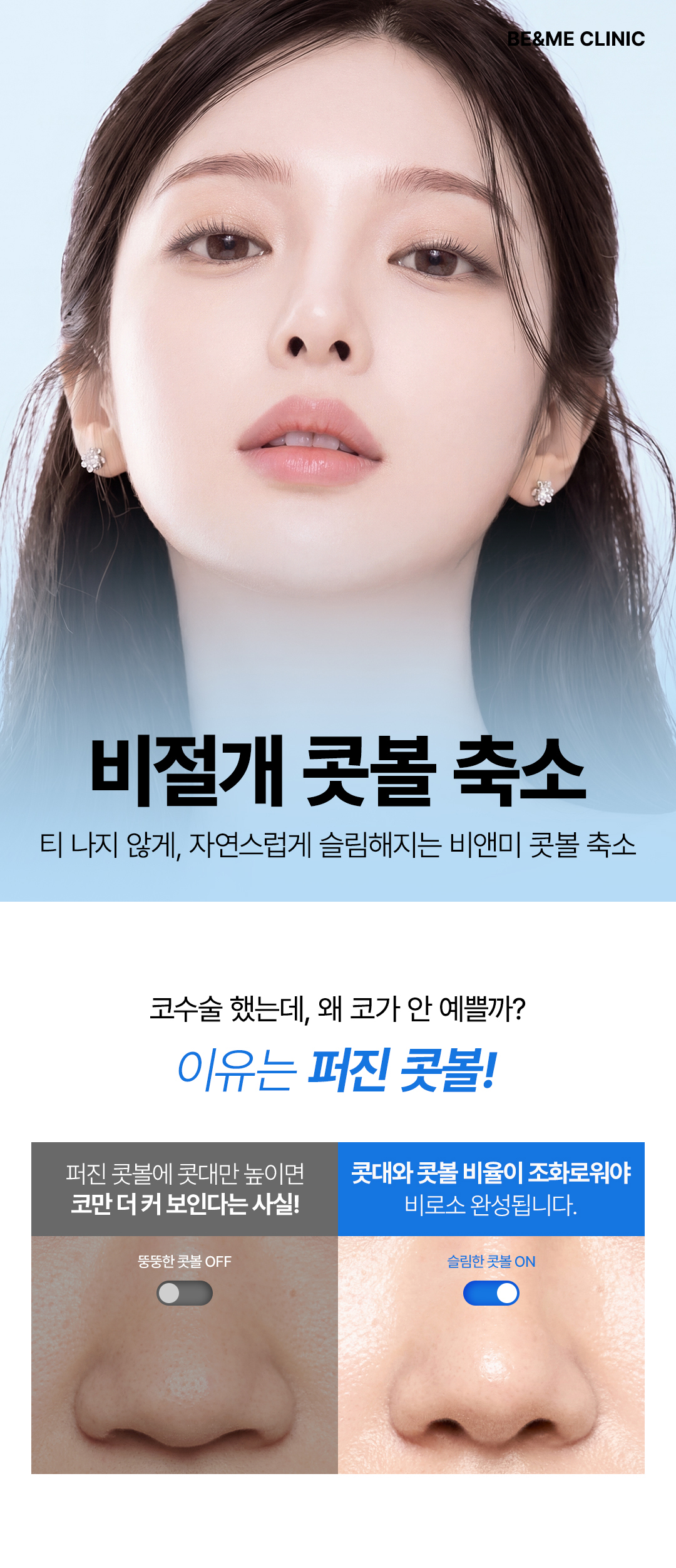 비절개 콧볼 축소, 비앤미 콧볼축소, 압구정 콧볼축소, 콧볼 비율