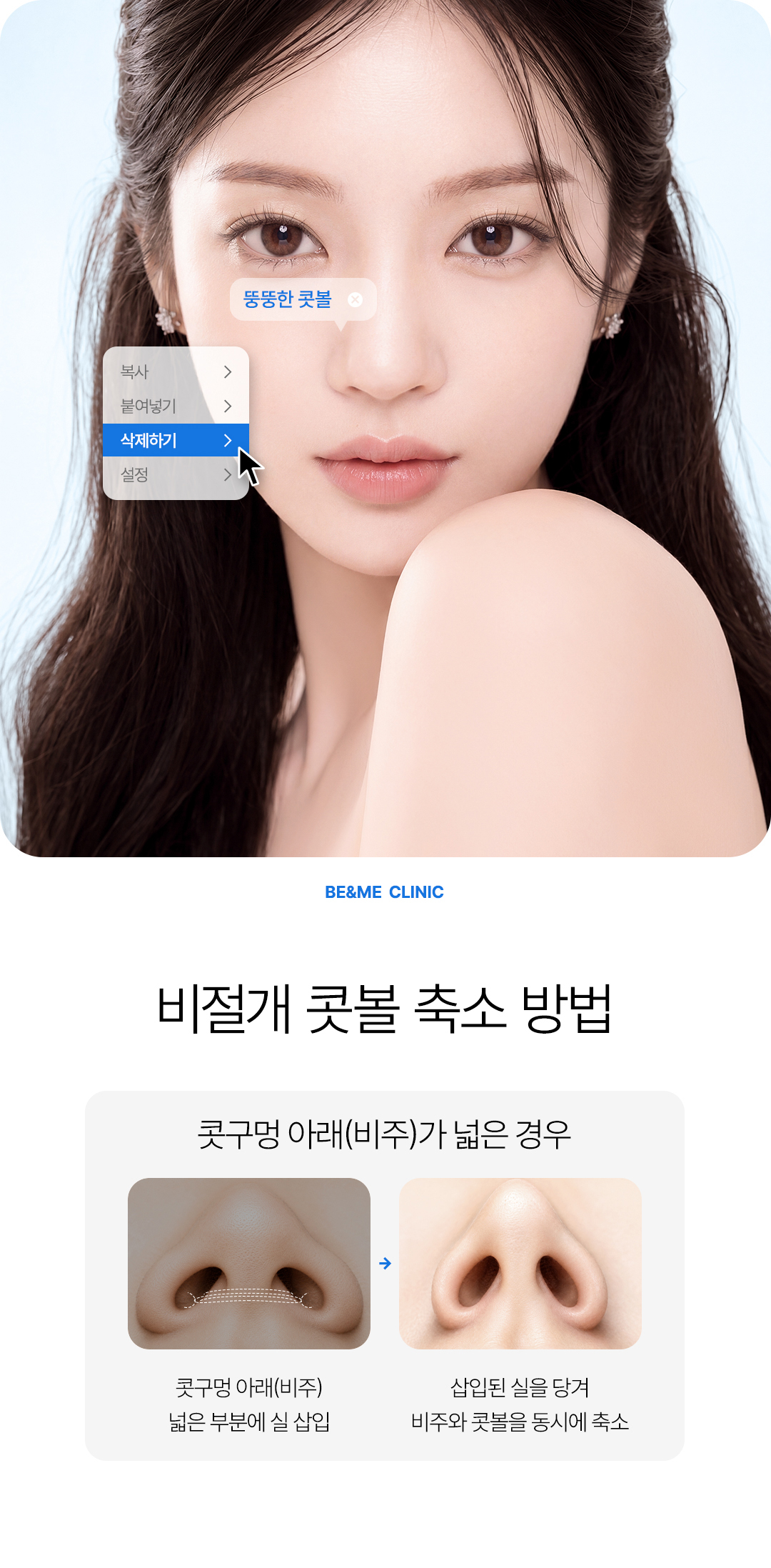 비절개 콧볼 축소, 콧볼 축소 방법, 비절개콧볼축소, 압구정 콧볼 축소