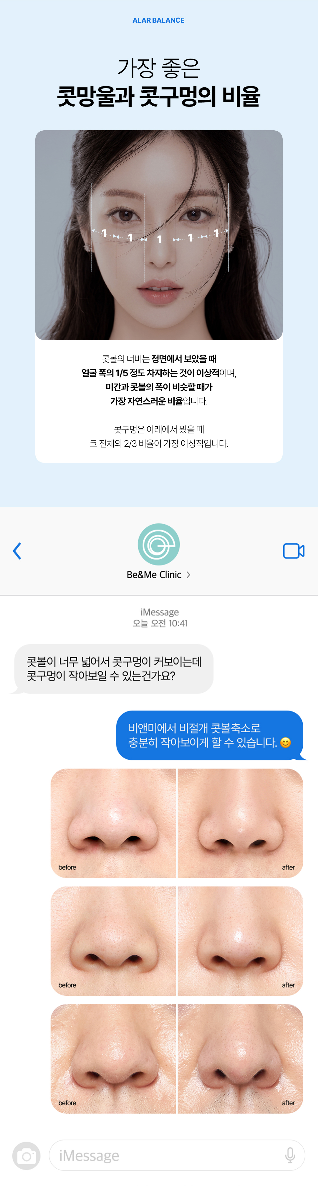 콧망울 콧구멍 비율, 비절개 콧볼 축소, 비앤미 콧볼축소, 압구정 콧볼축소, 콧볼 비율