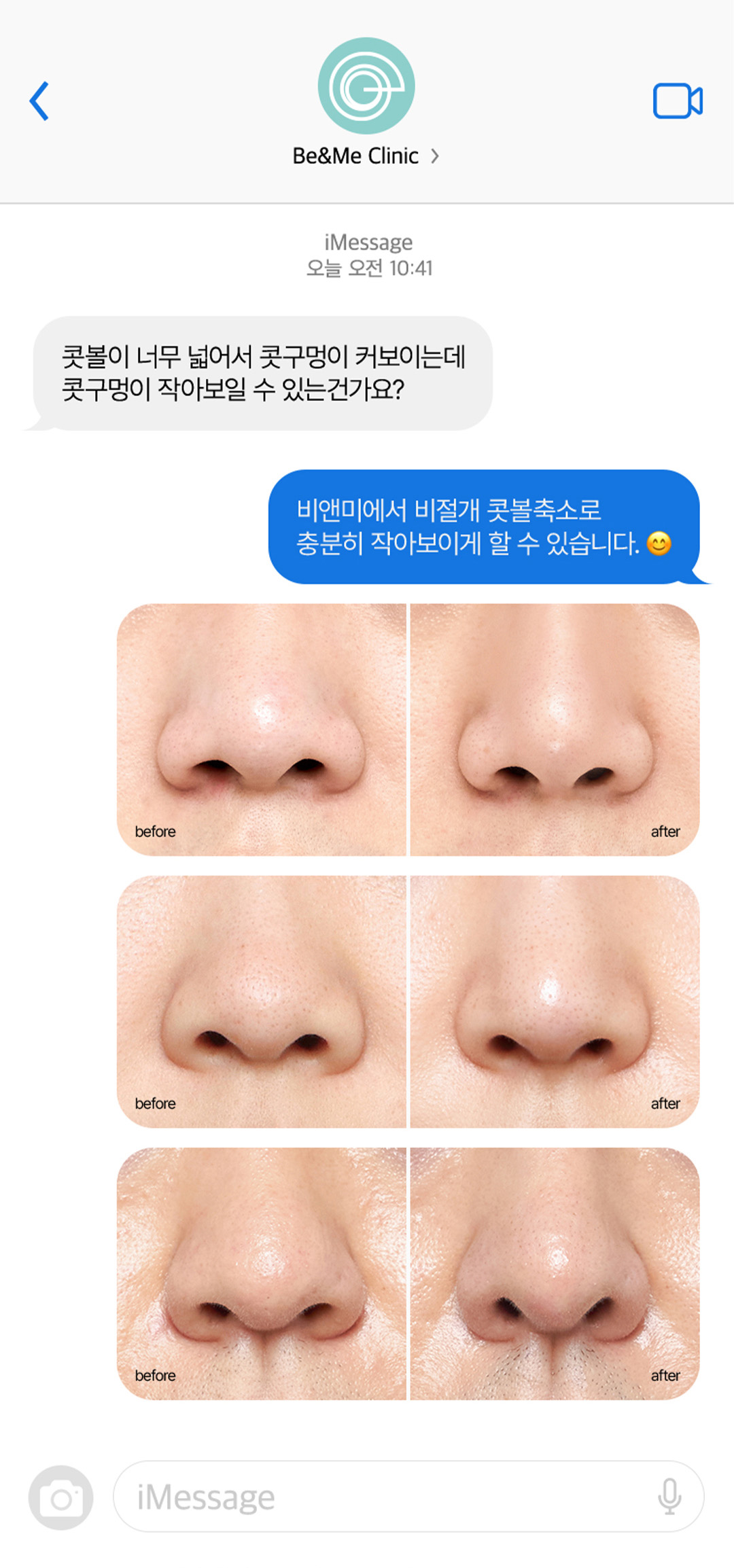 압구정 비앤미의원 비절개 콧볼 축소 시술 전후 비교 후기