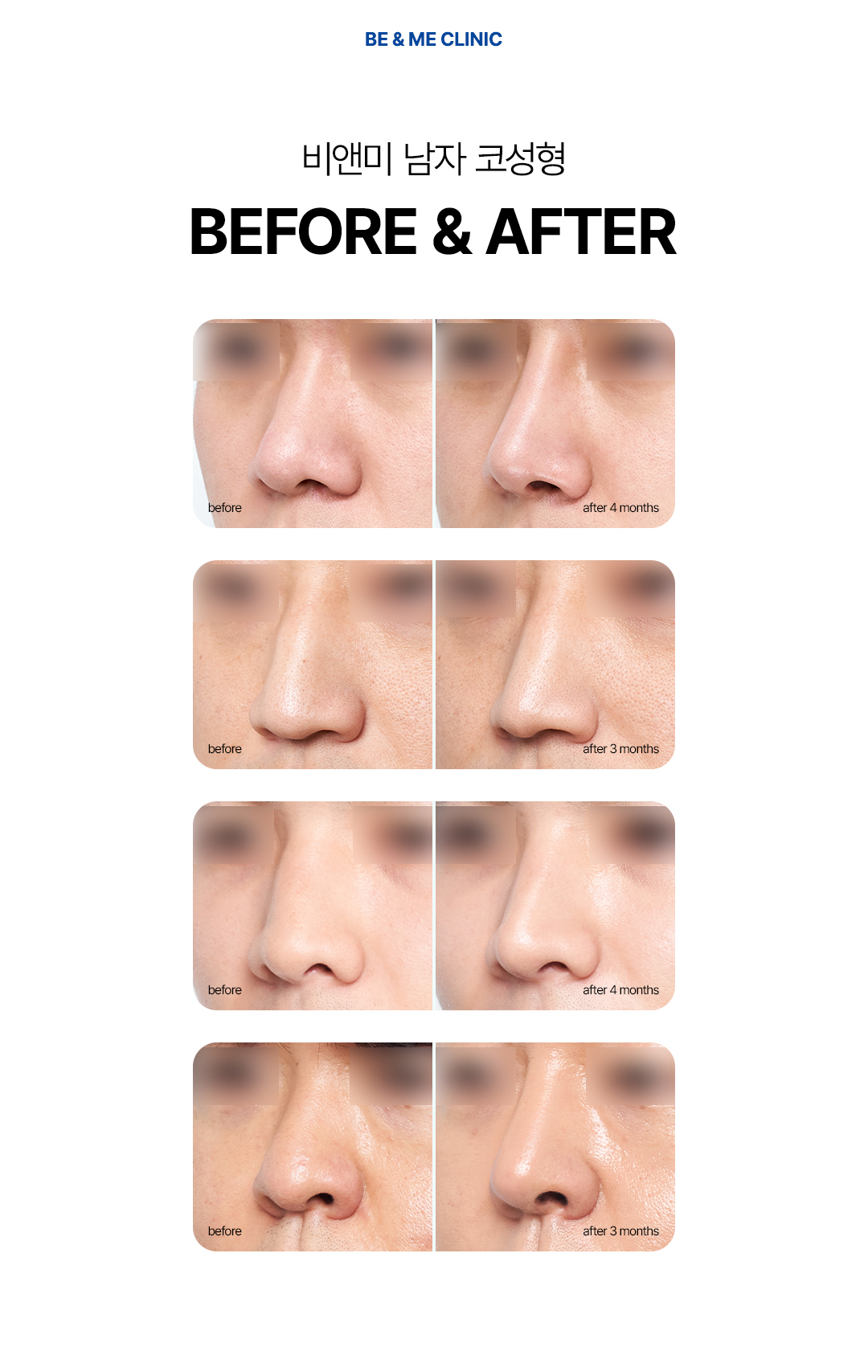 남자 코성형, 남자 코수술, 남자 코성형 잘하는 곳, 남자 코수술 후기, 남자 코성형 전후, 남자 콧대 성형, 남자 코끝 성형, 남자 매부리코 성형, 남자 휜코 성형, 남자 복코 성형, 남자 맞춤 코성형