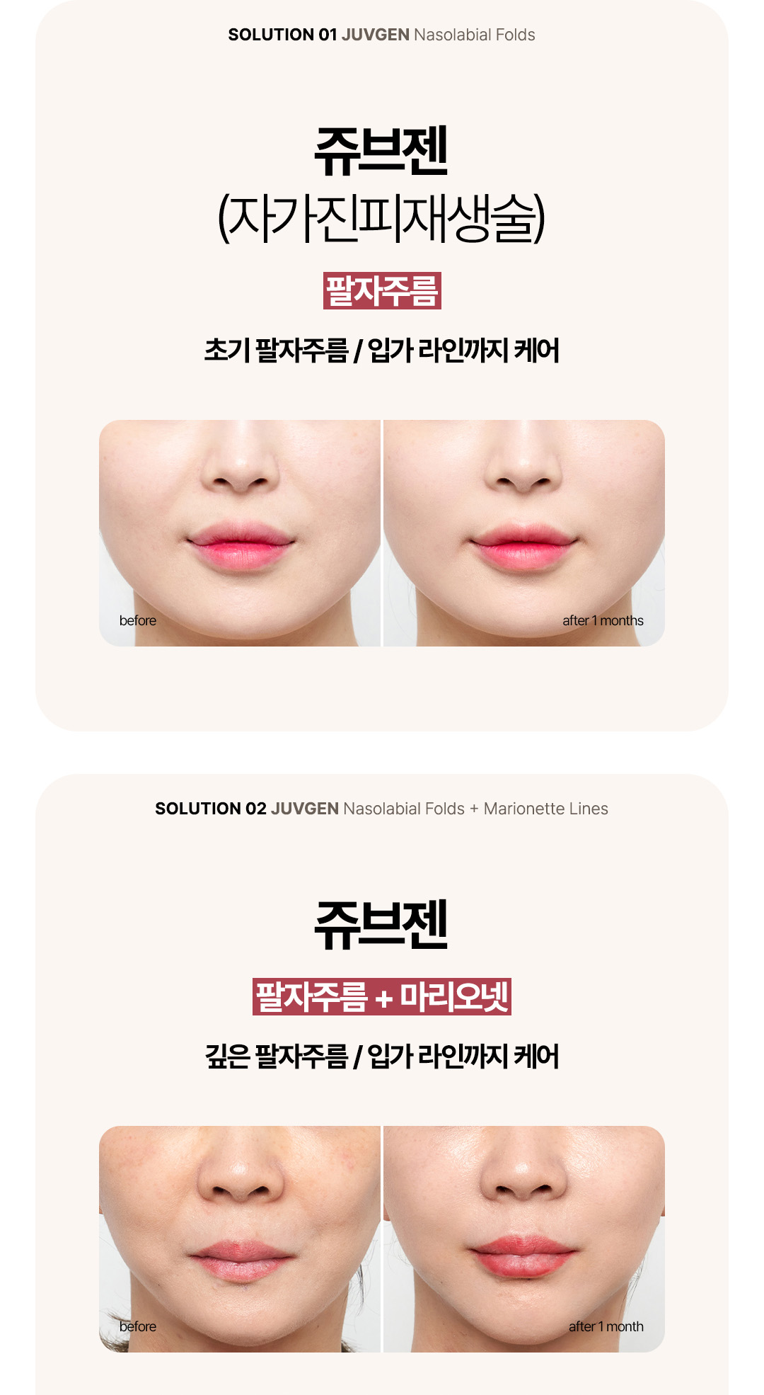 팔자주름시술 및 이중턱 개선을 위한 쥬브젠 민트실리프팅 효과
