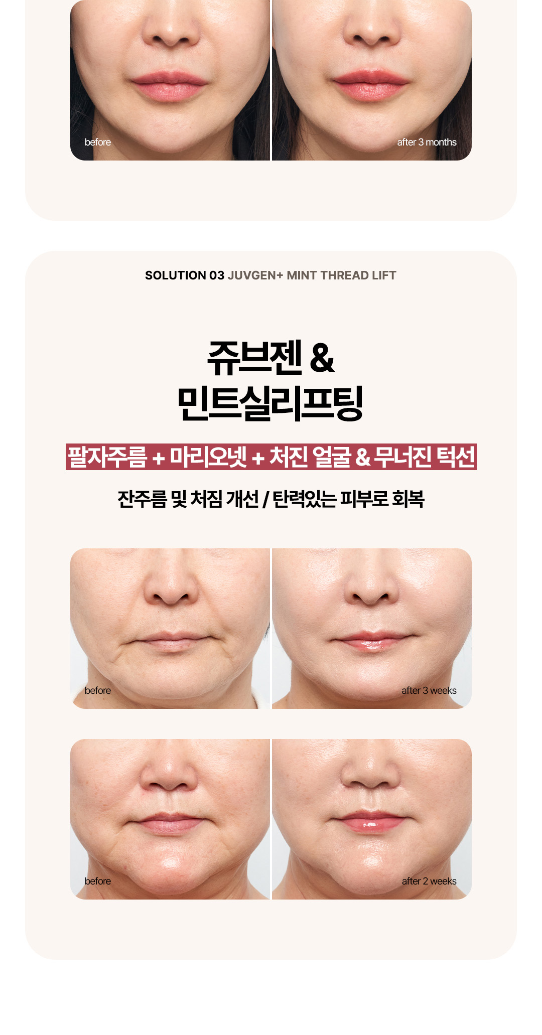 압구정비앤미 얼굴처짐 및 볼살 리프팅 시술 전후 비교와 턱선 개선