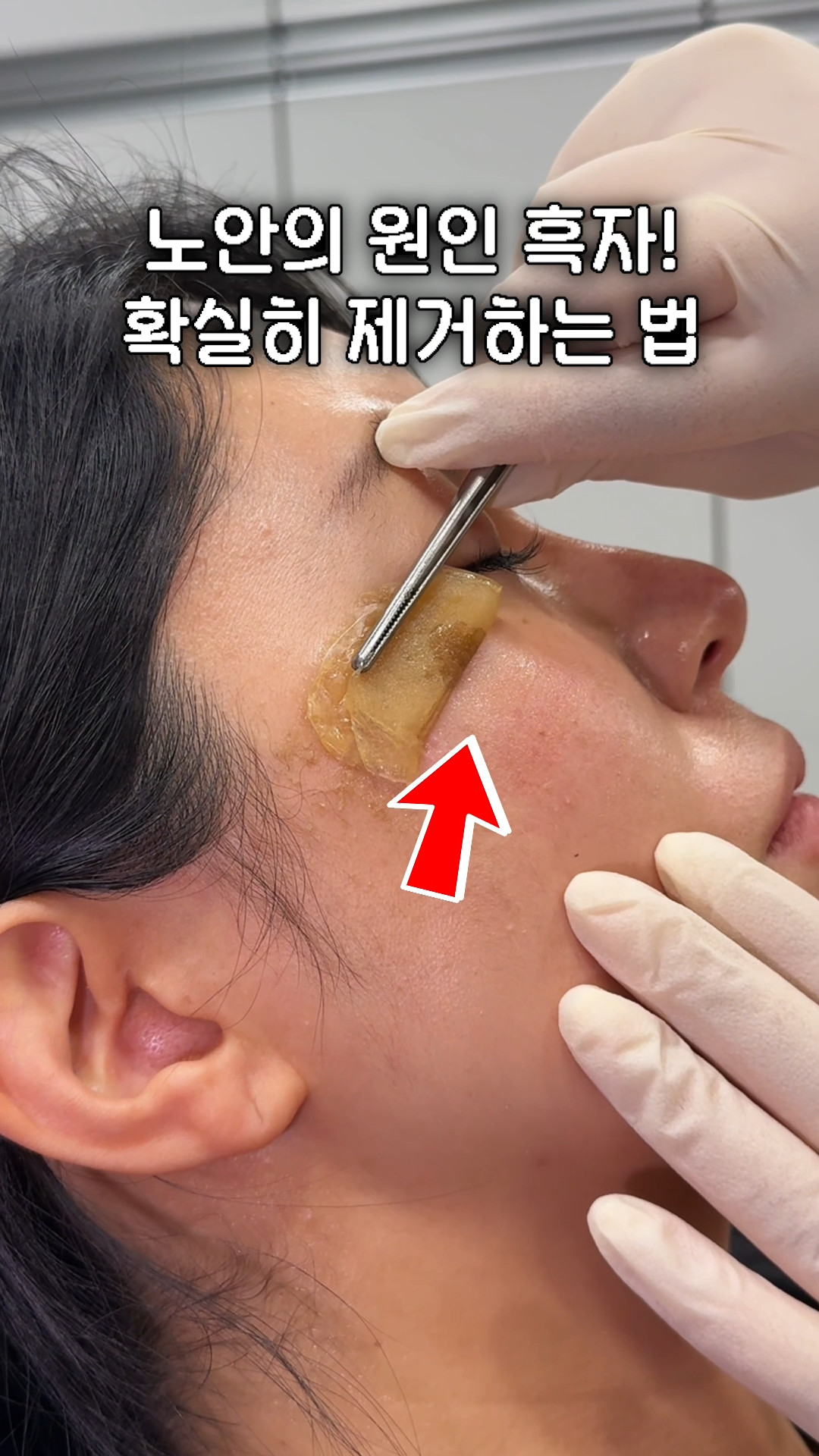 흑자제거