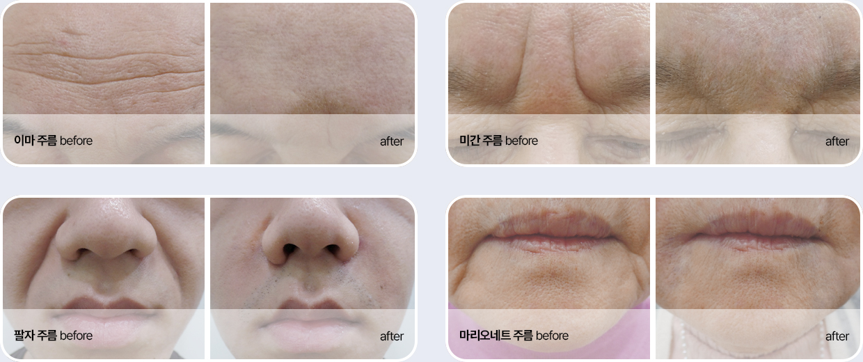 이마주름, 미간주름, 팔자주름, 마리오네트 주름