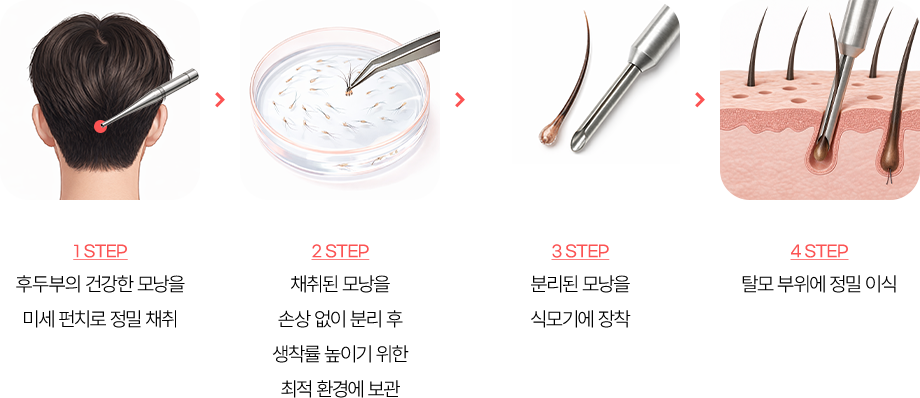 비절개 모발이식 수술방법