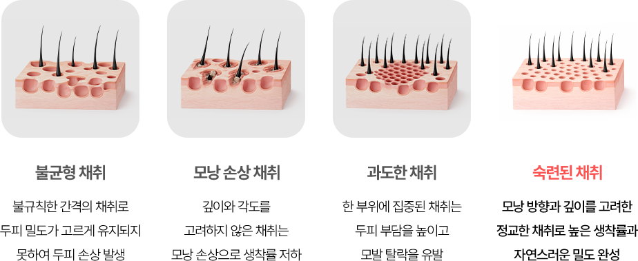 비절개 모발이식 POINT